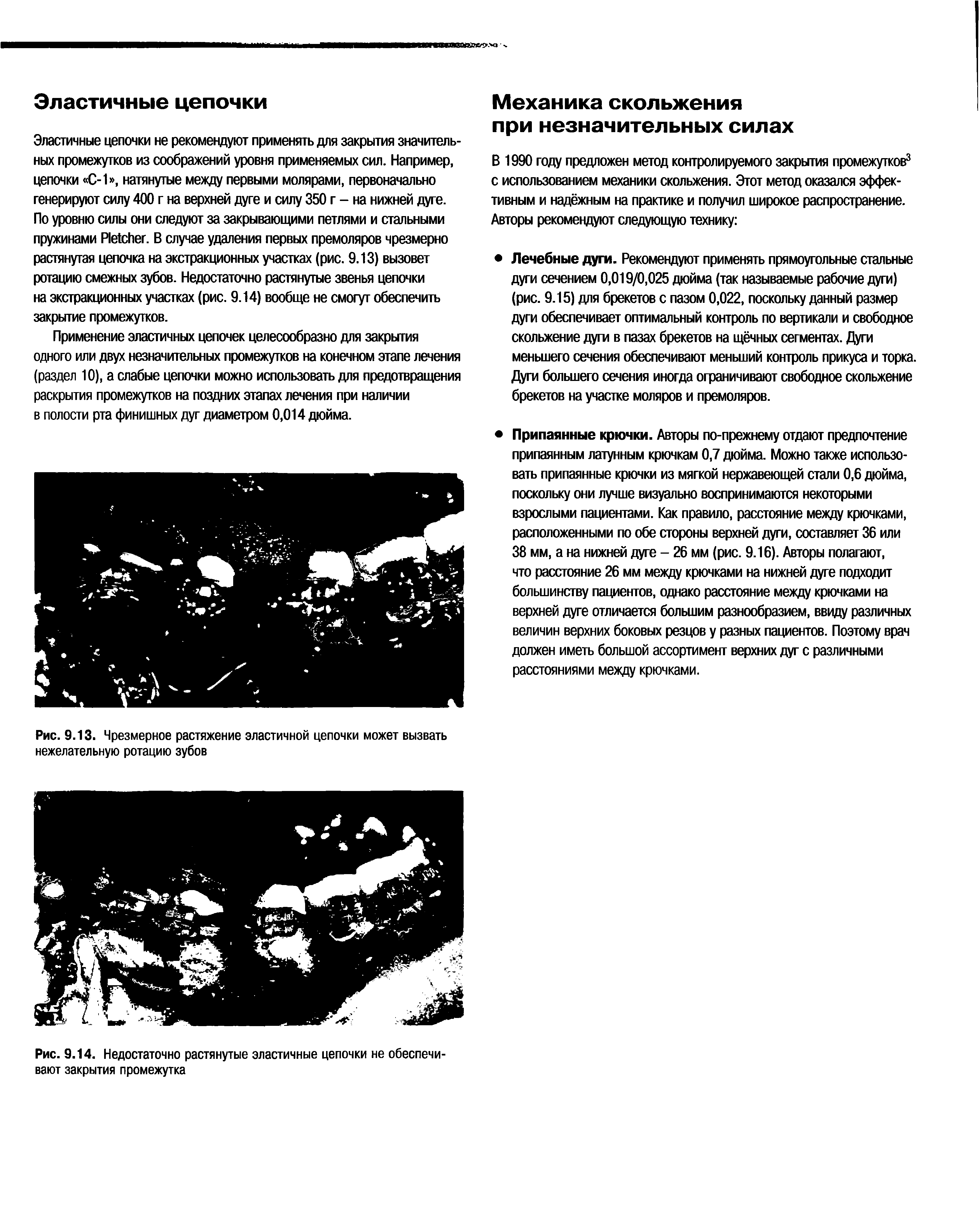 Рис. 9.13. Чрезмерное растяжение эластичной цепочки может вызвать нежелательную ротацию зубов...