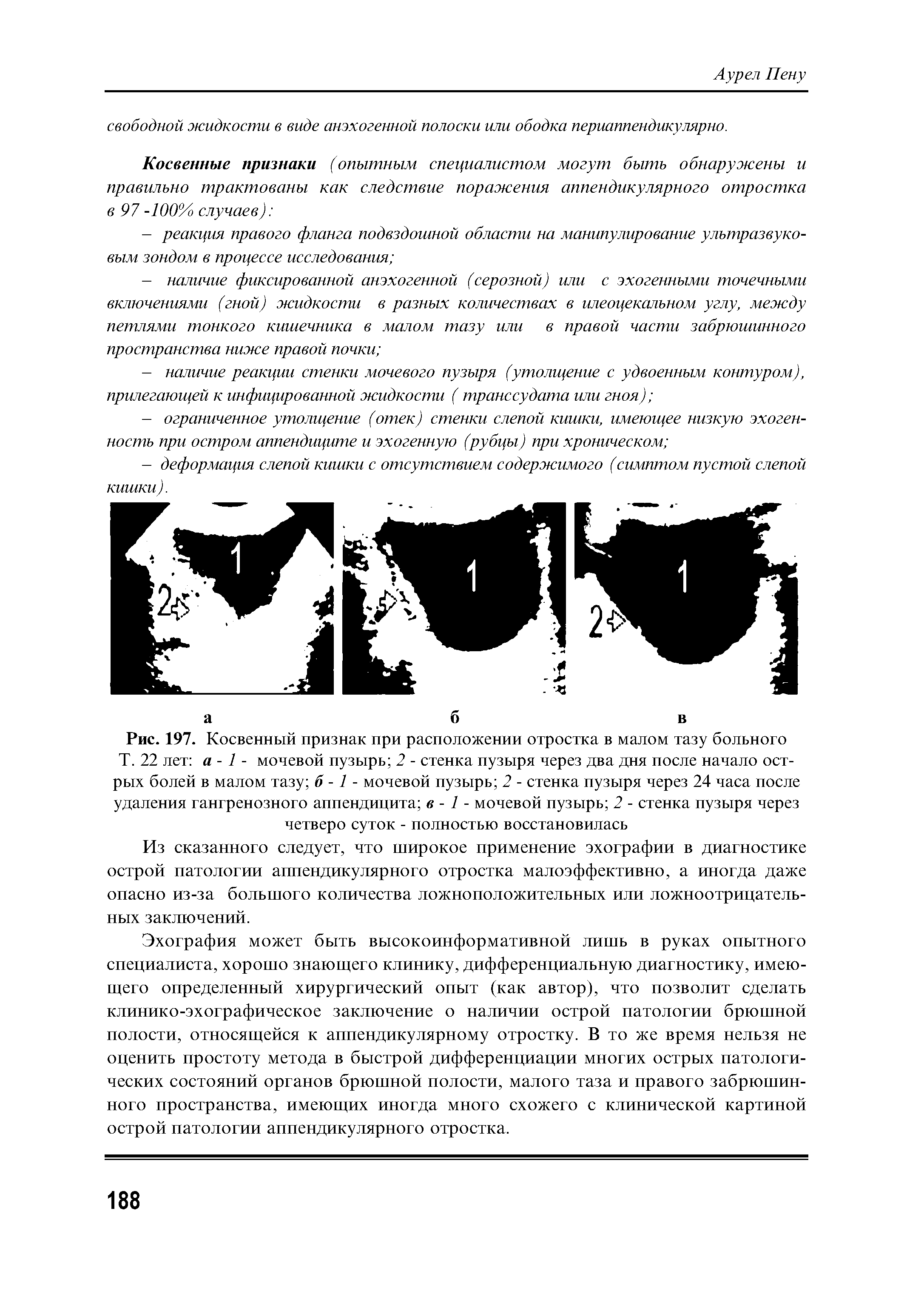 Рис. 197. Косвенный признак при расположении отростка в малом тазу больного Т. 22 лет а - 1 - мочевой пузырь 2 - стенка пузыря через два дня после начало острых болей в малом тазу б -1 - мочевой пузырь 2 - стенка пузыря через 24 часа после удаления гангренозного аппендицита в - 1 - мочевой пузырь 2 - стенка пузыря через четверо суток - полностью восстановилась...