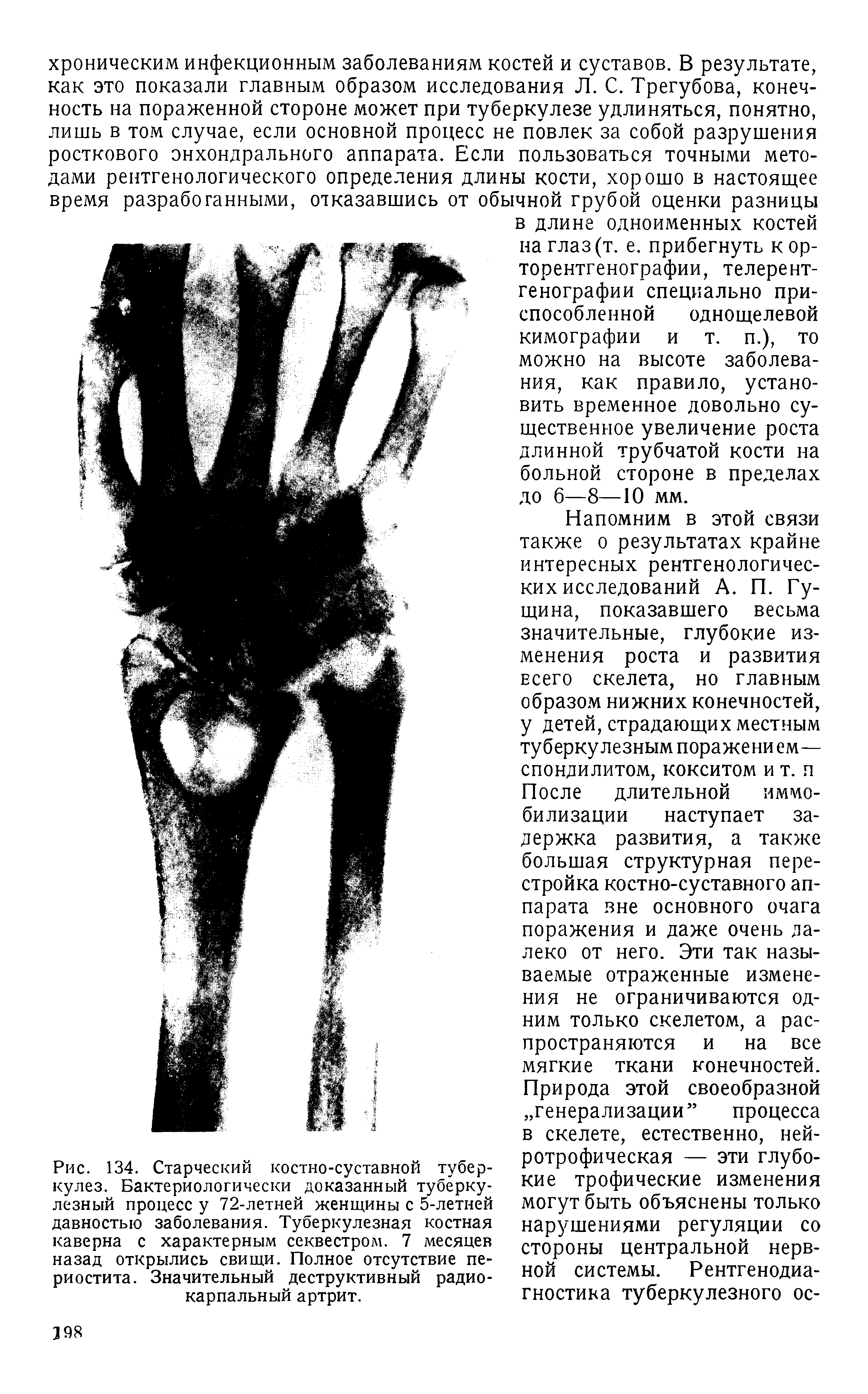 Рис. 134. Старческий костно-суставной туберкулез. Бактериологически доказанный туберкулезный процесс у 72-летней женщины с 5-летней давностью заболевания. Туберкулезная костная каверна с характерным секвестром. 7 месяцев назад открылись свищи. Полное отсутствие периостита. Значительный деструктивный радио-карпальный артрит.