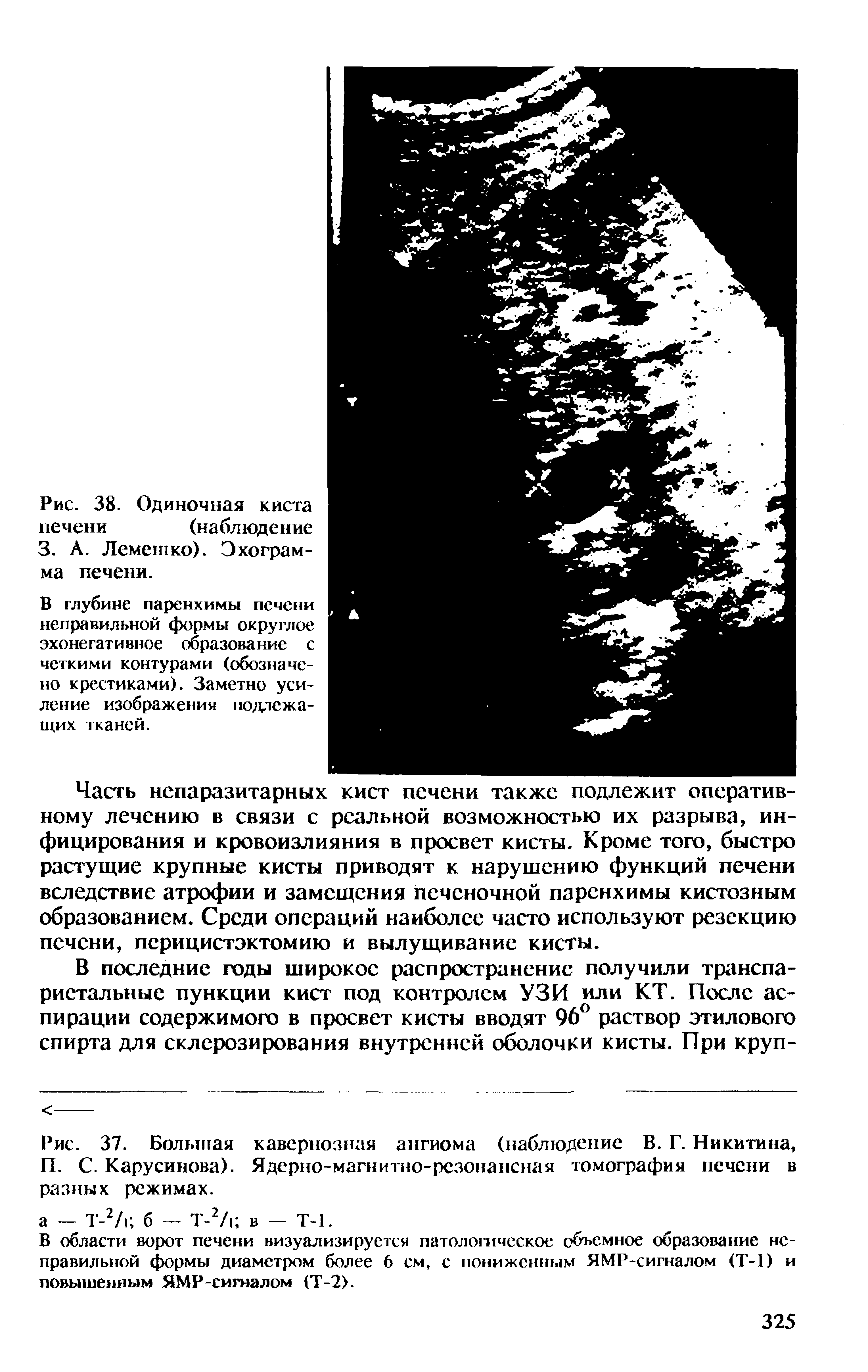 Рис. 37. Большая кавернозная ангиома (наблюдение В. Г. Никитина, П. С. Карусинова). Ядерно-магнитно-рсзонансная томография печени в разных режимах.