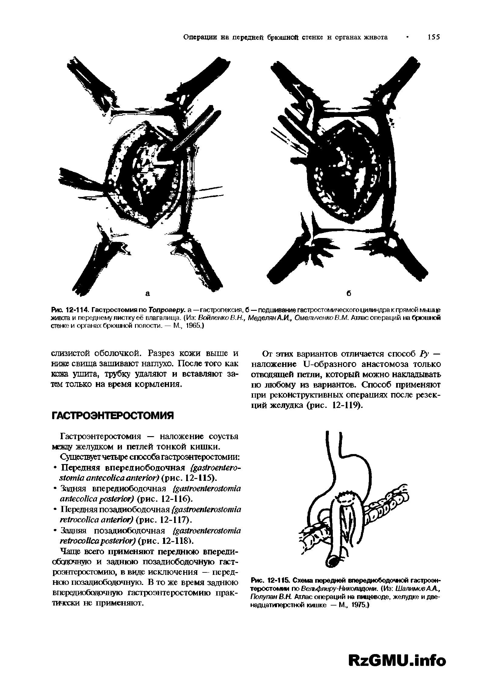 Рис. 12-115. Схема передней впередиободочной гастроэнтеростомии по Вет флеру-Никогщцони. (Из Шалимов А.А., Полупан В.Н Атлас операций на пищеводе, желудке и двенадцатиперстной кишке — М., 1975.)...