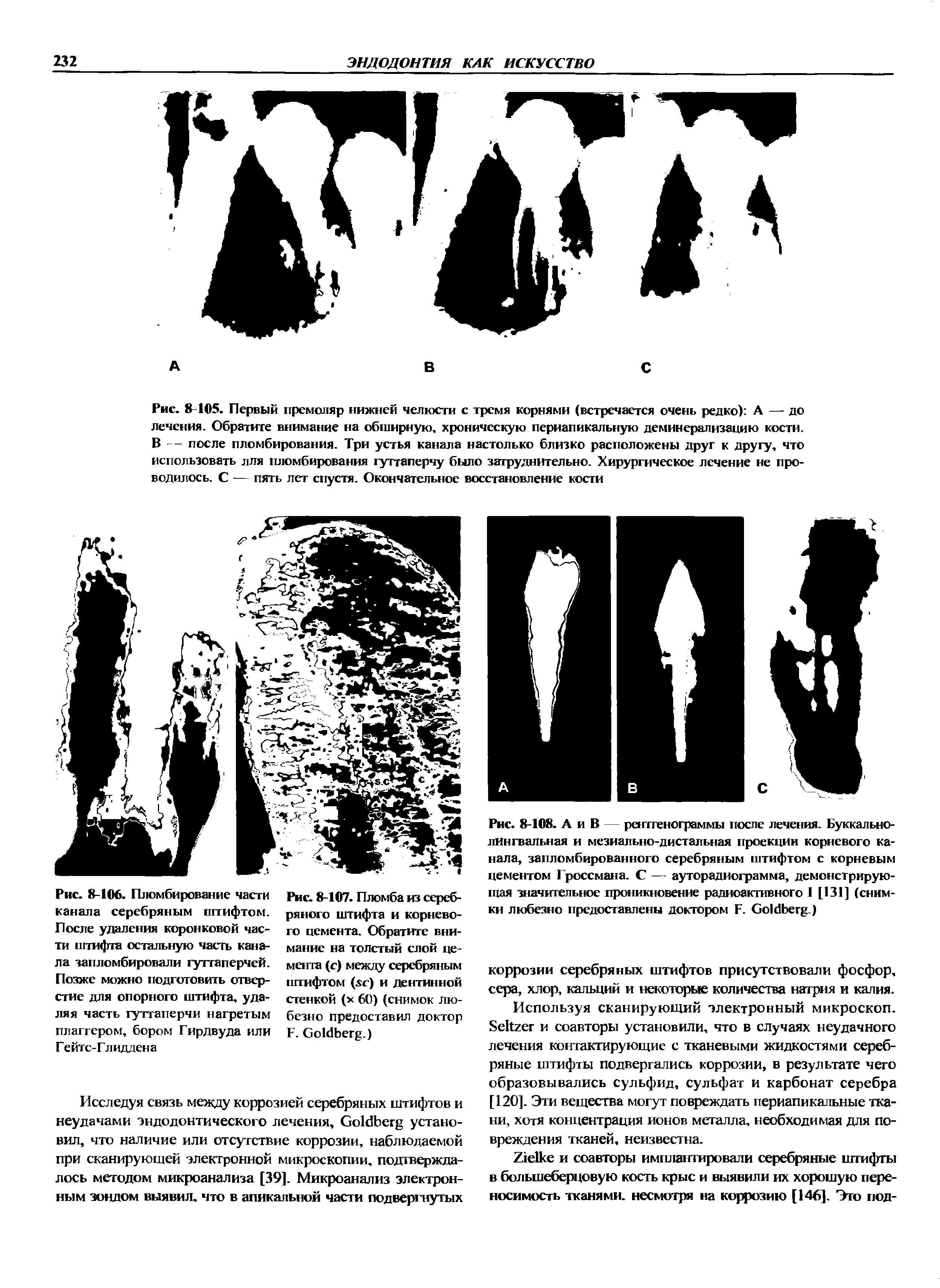 Рис. 8-108. А и В — рентгенограммы после лечения. Буккальнолингвальная и мезиально-дистальная проекции корневого канала, запломбированного серебряным штифтом с корневым цементом Гроссмана. С — ауторадиограмма, демонстрирующая значительное проникновение радиоактивного I [131] (снимки любезно предоставлены доктором F. G .)...