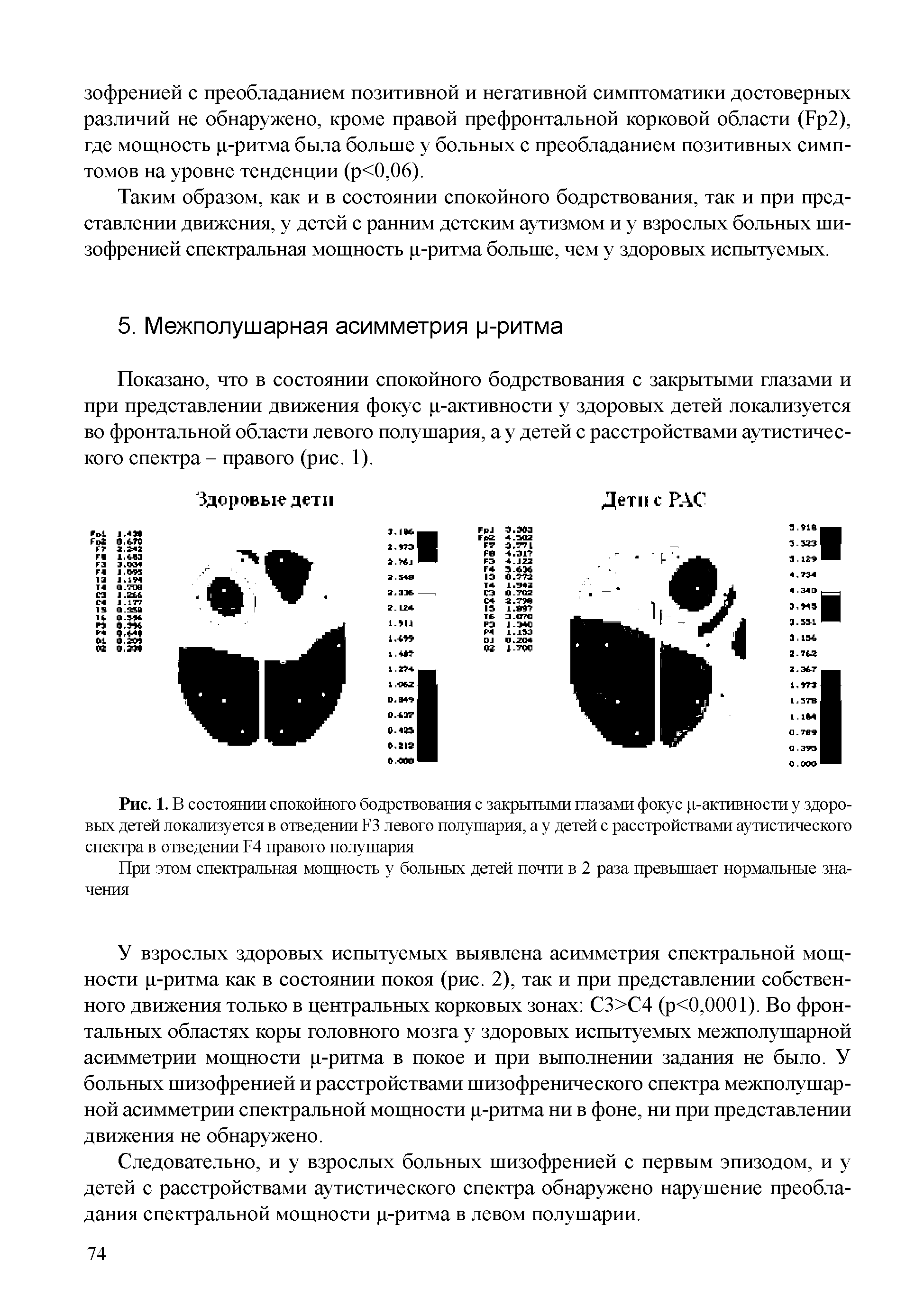 Рис. 1. В состоянии спокойного бодрствования с закрытыми глазами фокус ц-активности у здоровых детей локализуется в отведении 13 левого полушария, а у детей с расстройствами аутистического спектра в отведении 14 правого полушария...