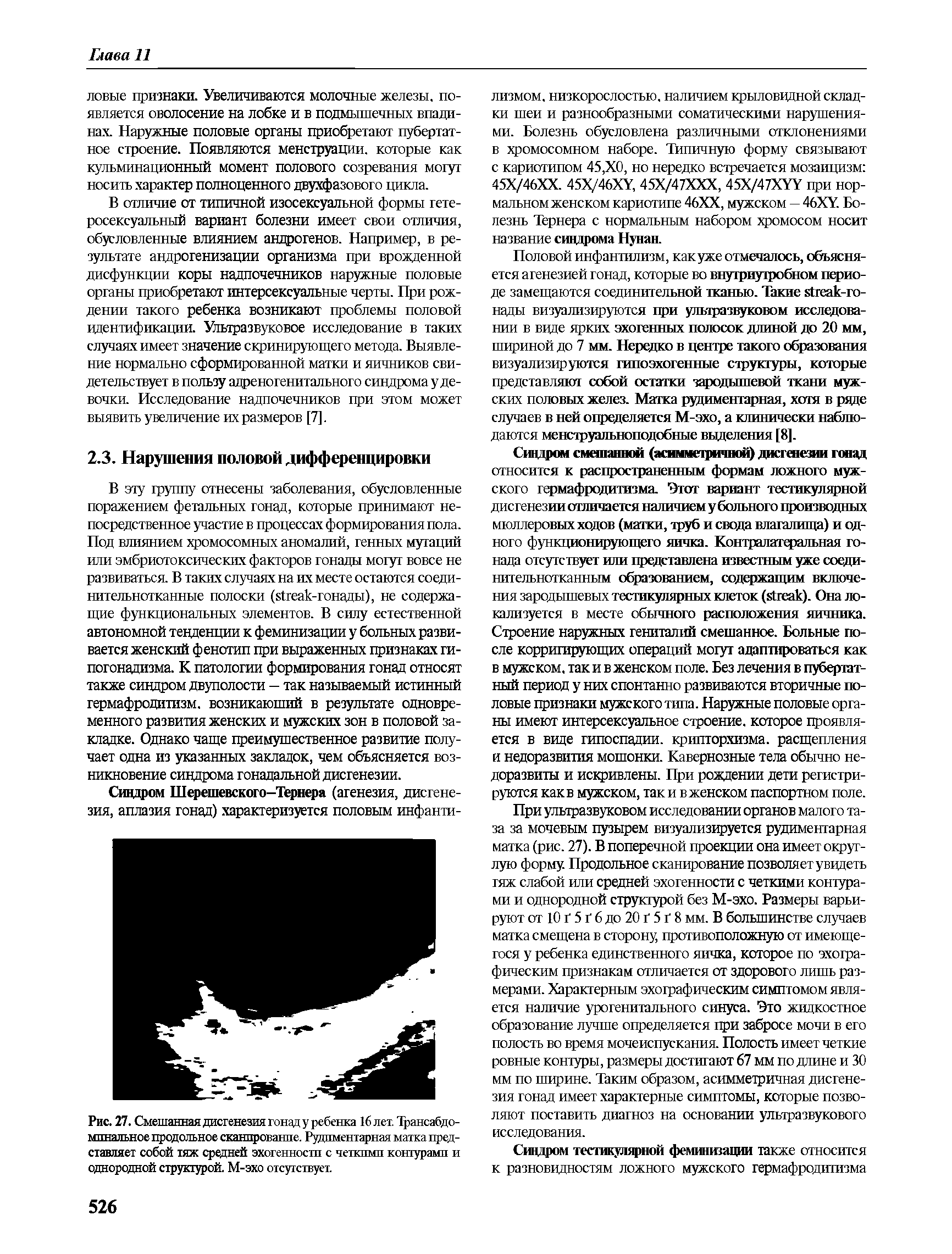 Рис. 27. Смешанная дисгенезия гонад у ребенка 16 лет. Трансабдо-мпнальное продольное сканирование. Рудиментарная матка представляет собой тяж средней эхогенности с четкими контурами и однородной структурой. М-эхо отсутствует.