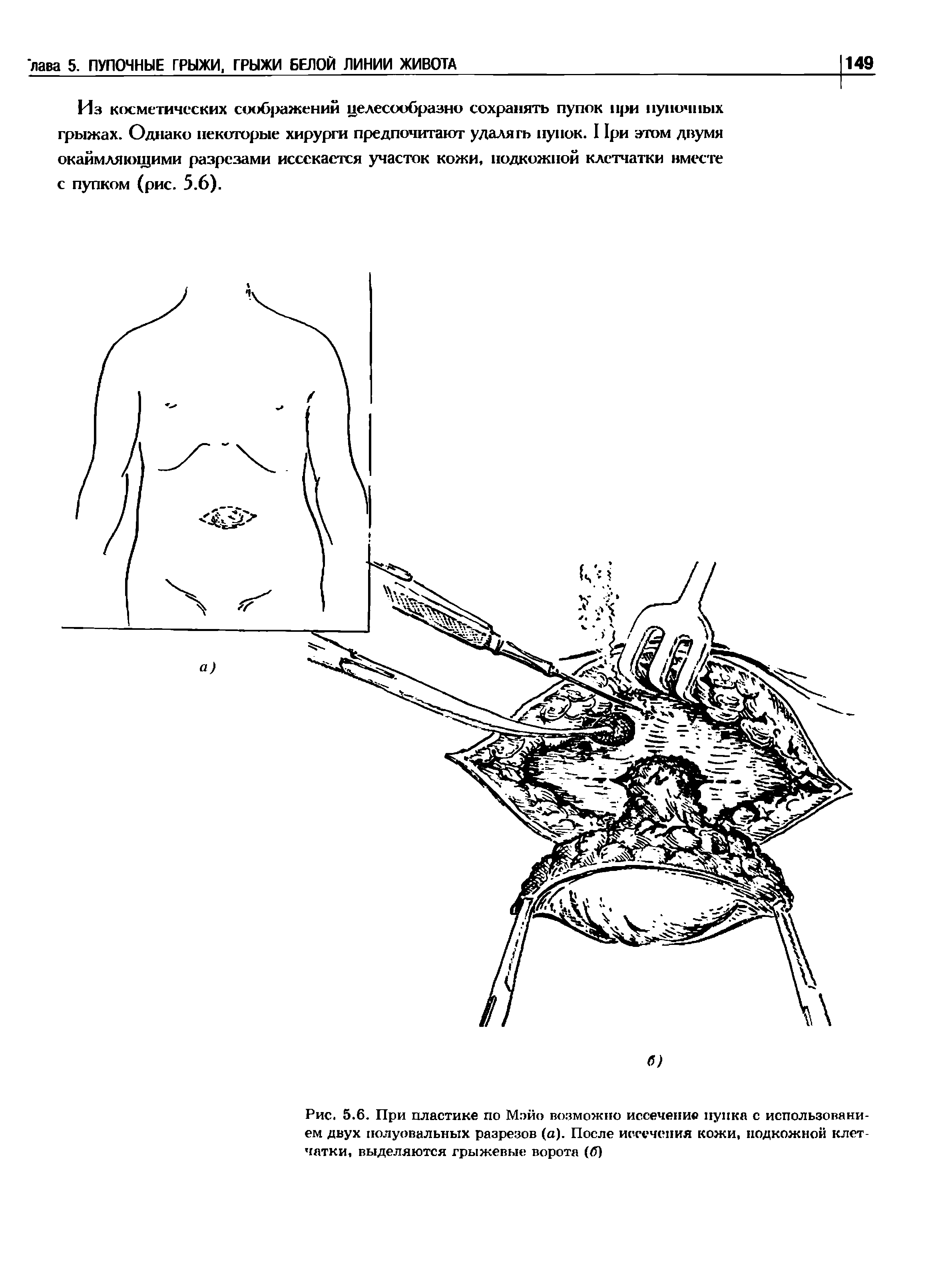 Рис. 5.6. При пластике по Мэйо возможно иссечение пупка с использованием двух полуовальных разрезов (а). После иссечения кожи, подкожной клетчатки, выделяются грыжевые ворота (б)...