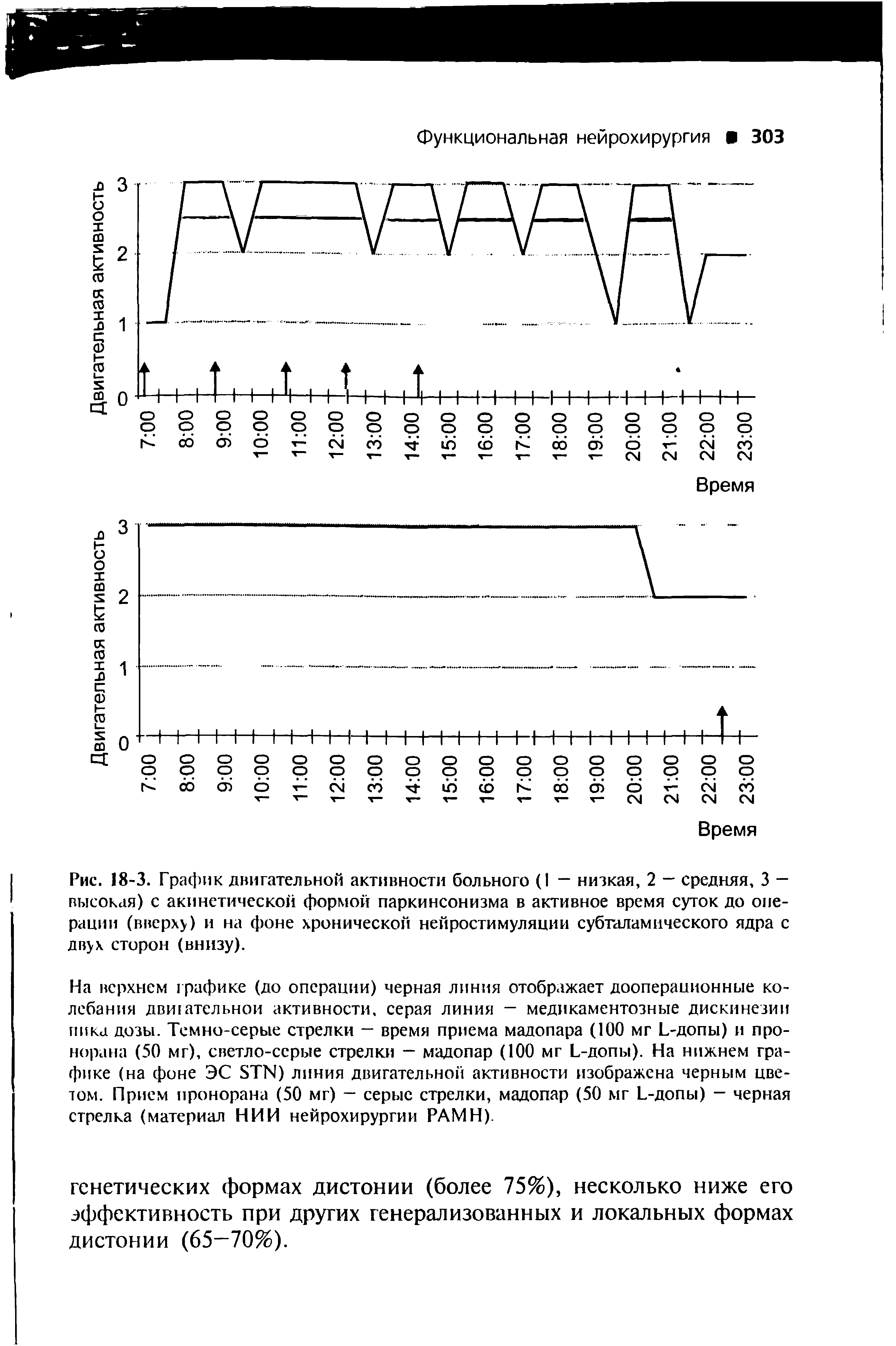 Рис. 18-3. График двигательной активности больного (I — низкая, 2 — средняя, 3 — высокая) с акинетической формой паркинсонизма в активное время суток до операции (вверху) и на фоне хронической нейростимуляции субталамического ядра с двух сторон (внизу).