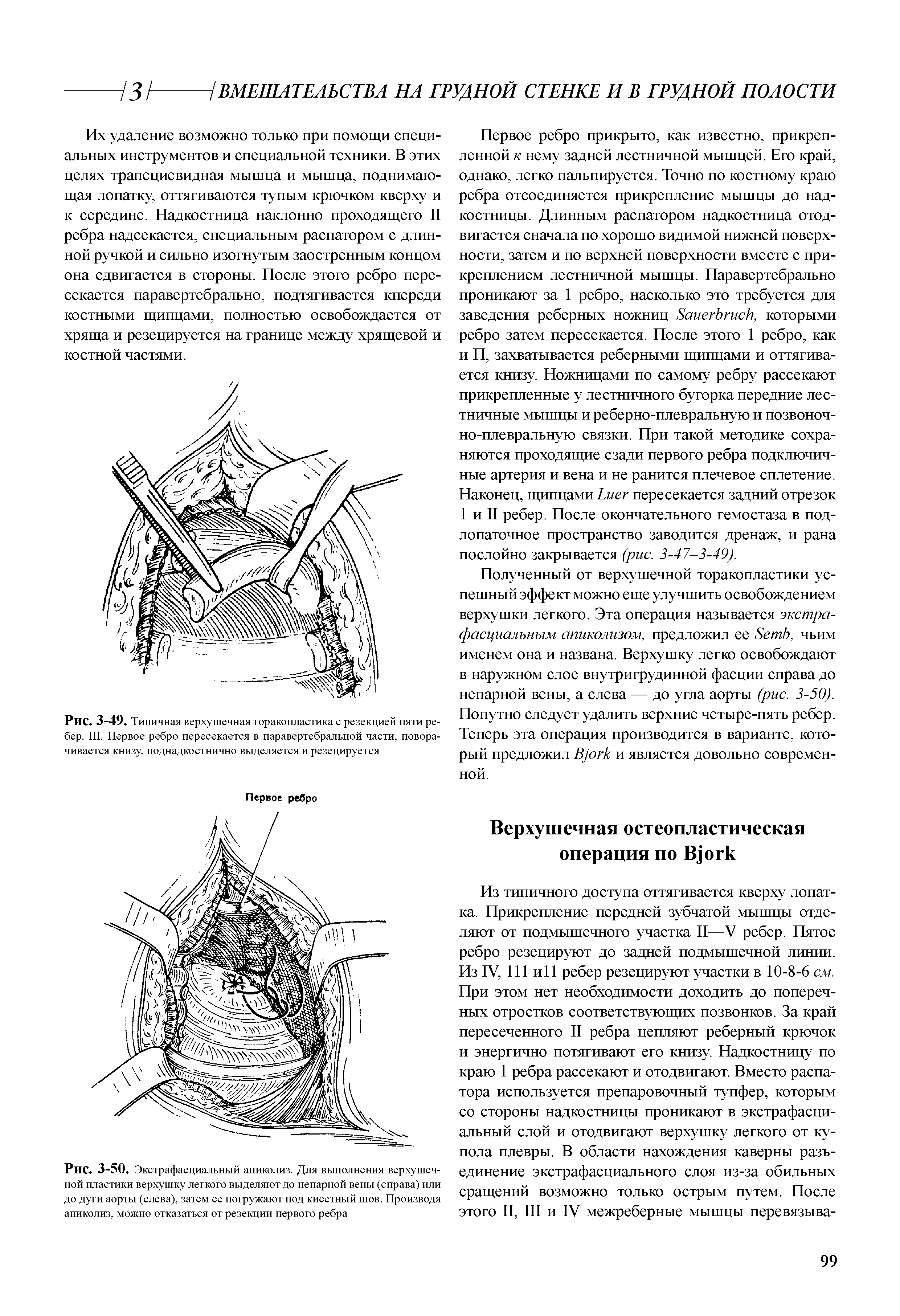Рис. 3-49. Типичная верхушечная торакопластика с резекцией пяти ребер. III. Первое ребро пересекается в паравертебральной части, поворачивается книзу, поднадкостнично выделяется и резецируется...