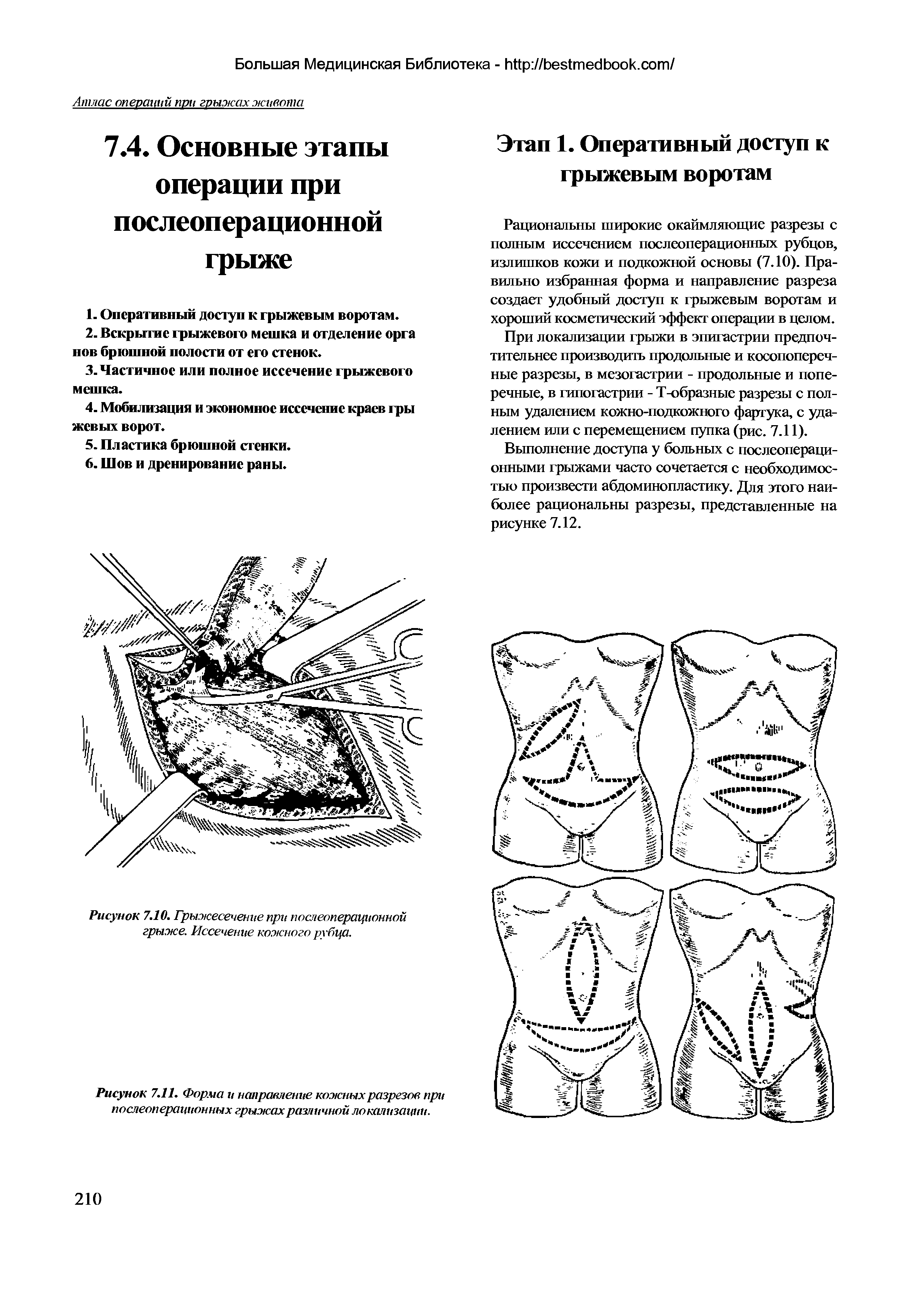 Рисунок 7.10. Грыжесечение при послеоперационной грыже. Иссечение кожного рубца.