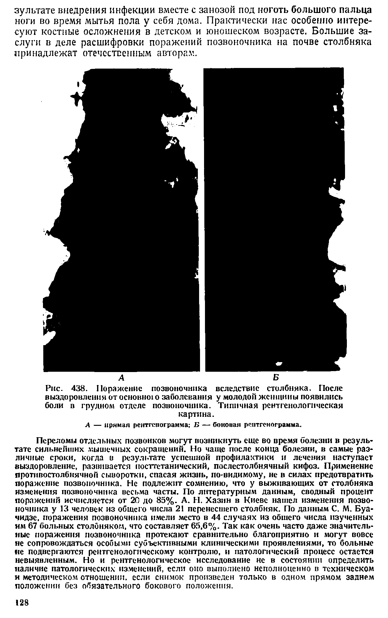 Рис. 438. Поражение позвоночника вследствие столбняка. После выздоровления от основног о заболевания у молодой женщины появились боли в грудном отделе позвоночника. Типичная рентгенологическая картина.