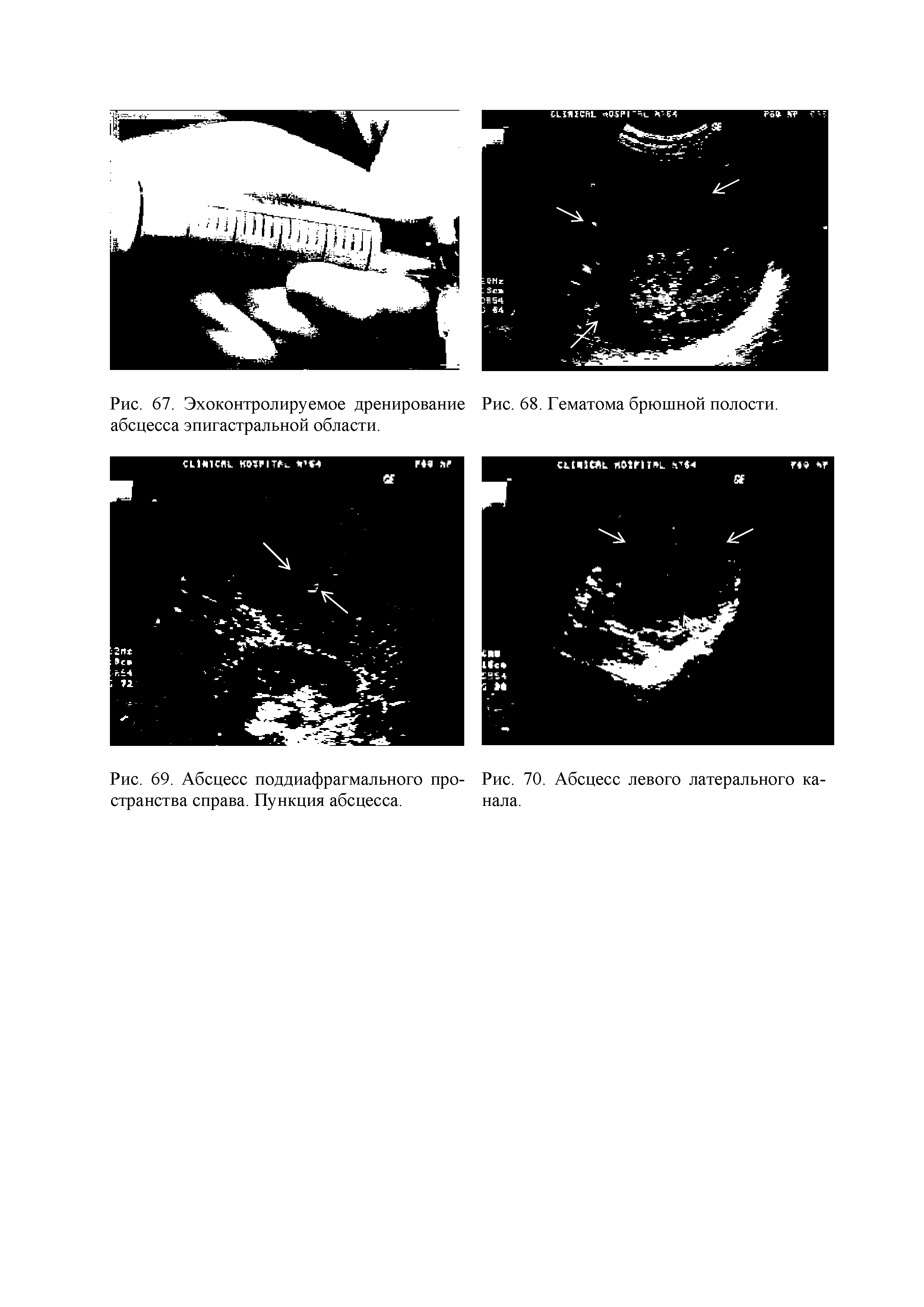 Рис. 69. Абсцесс поддиафрагмального пространства справа. Пункция абсцесса.