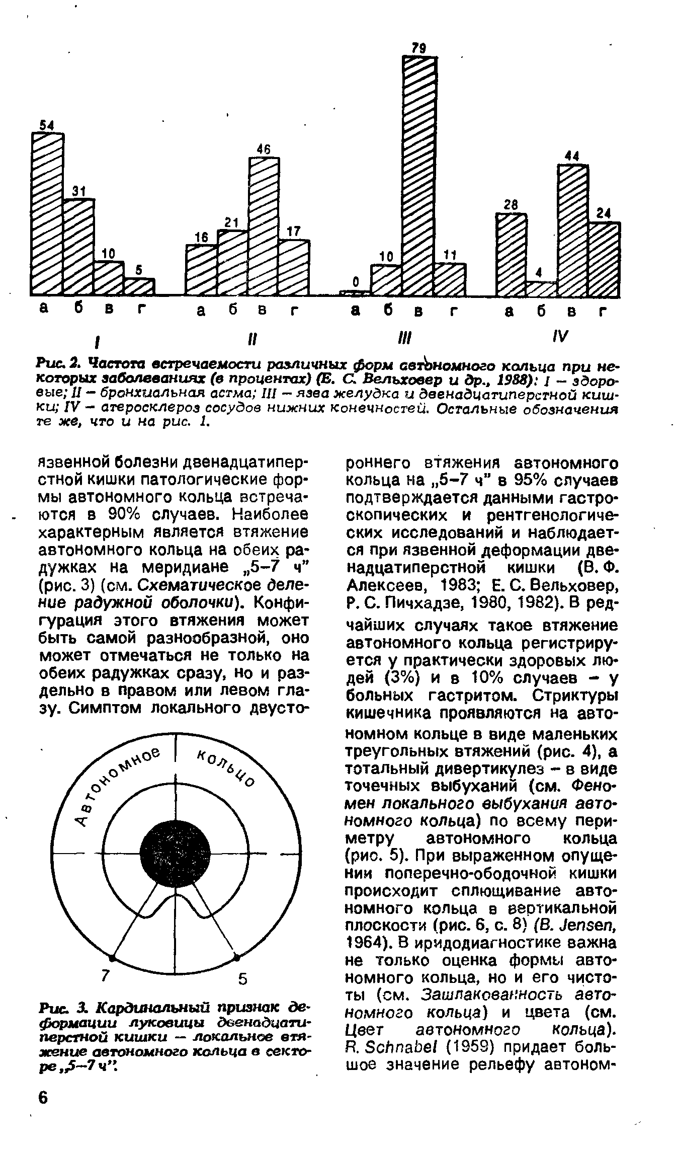 Рис. 3. Кардинальный признак деформации луковицы двенадцатиперстной кишки — локальное втяжение автономного кольца в секторе, -7 ч .