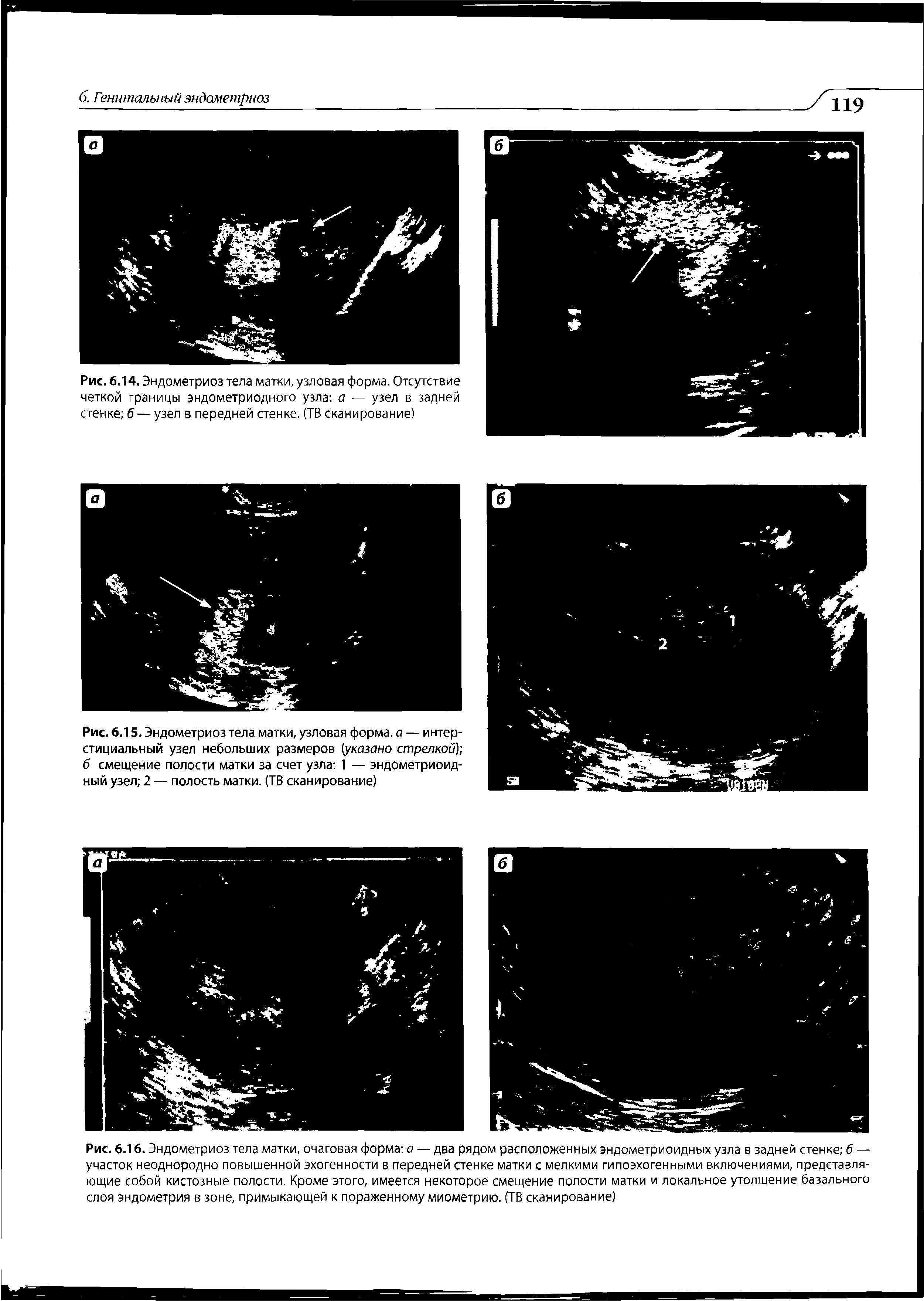 Рис. 6.14. Эндометриоз тела матки, узловая форма. Отсутствие четкой границы эндометриодного узла а — узел в задней стенке б — узел в передней стенке. (ТВ сканирование)...