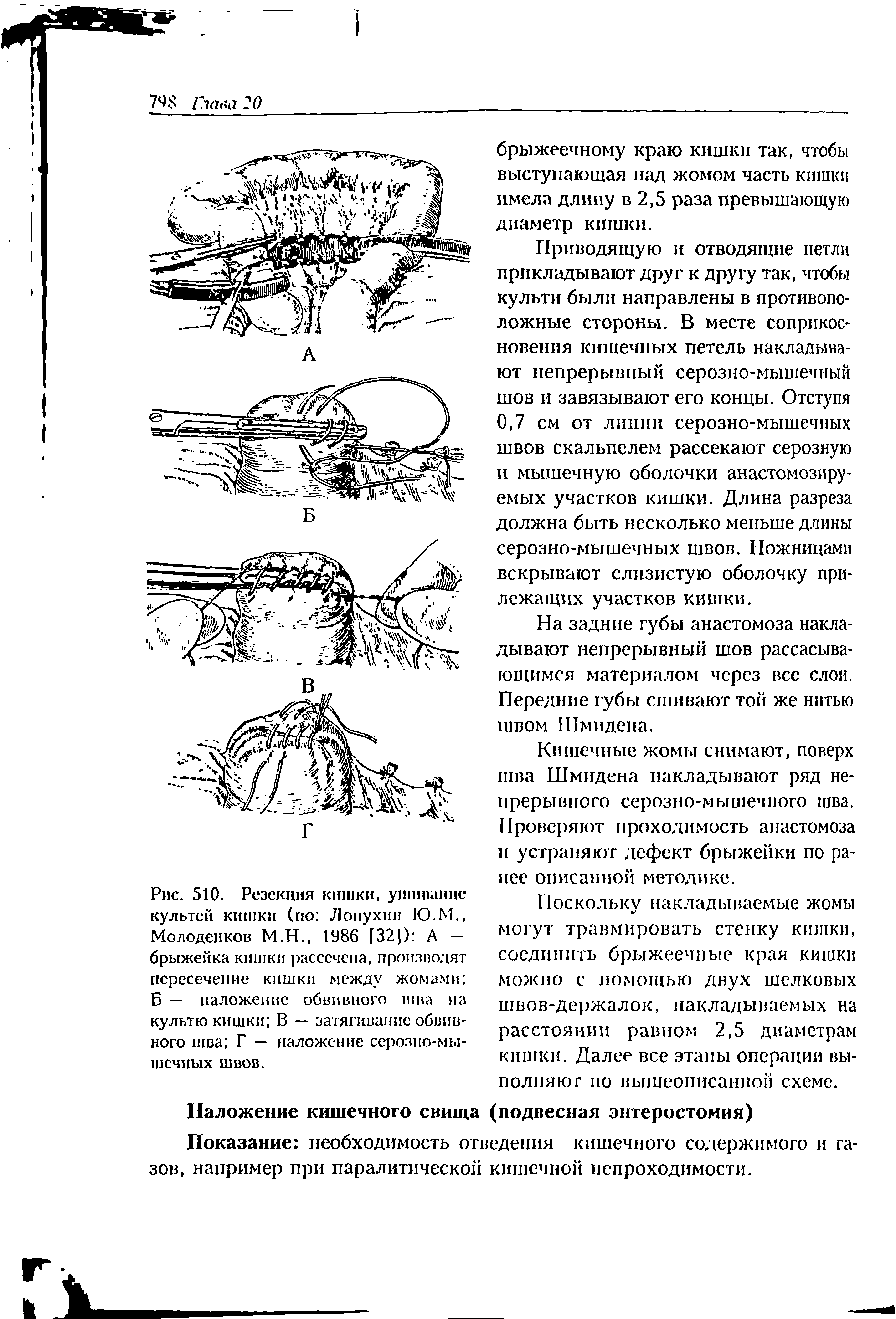 Рис. 510. Резекция кишки, ушивание культей кишки (по Лопухин Ю.М., Молоденков М.Н., 1986 [32]) А — брыжейка кишки рассечена, производят пересечение кишки между жомами Б — наложение обвивного шва на культю кишки В — затягивание обвивного шва Г — наложение серозно-мышечных швов.