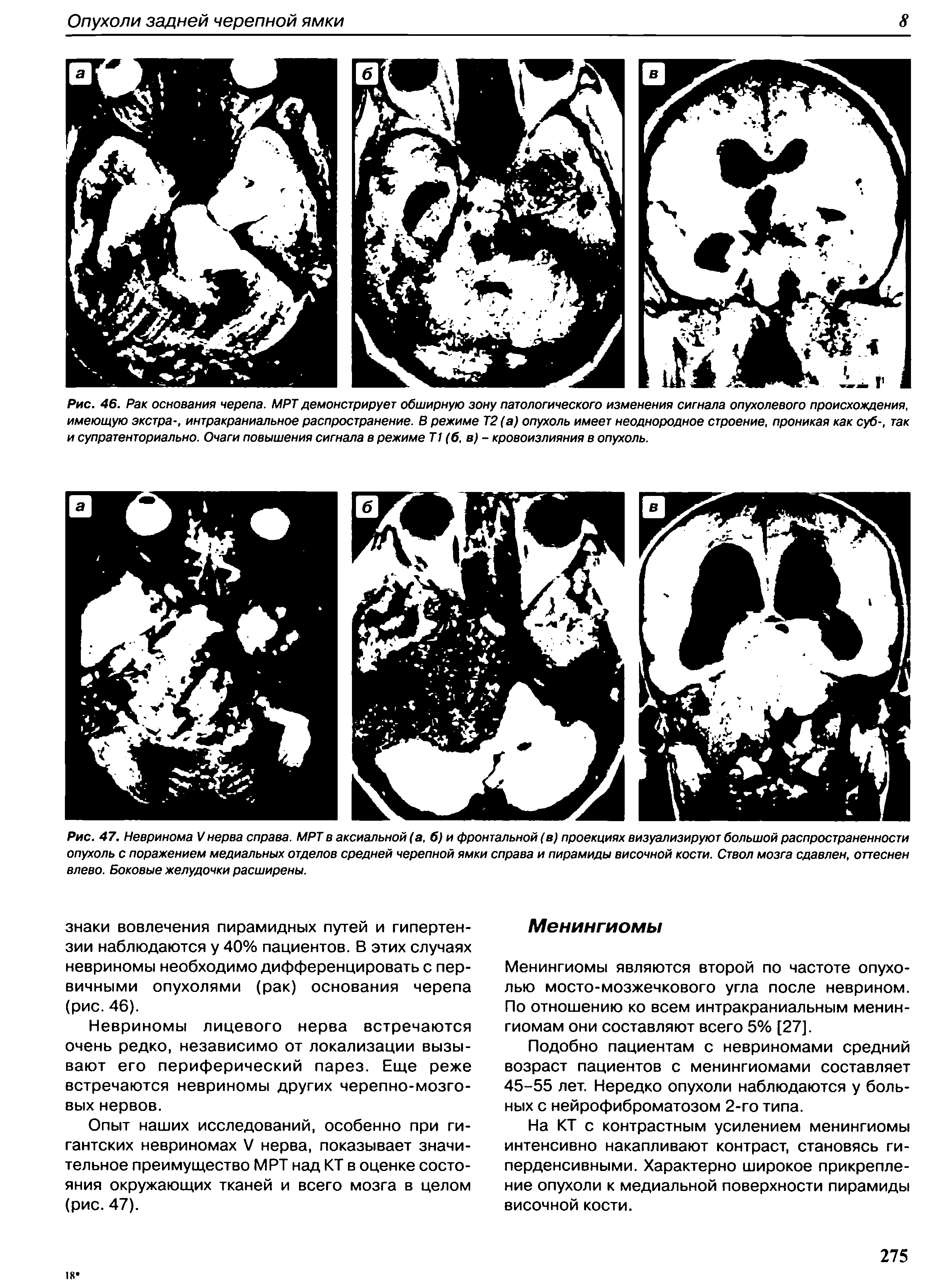 Рис. 47. Невринома V нерва справа. МРТ в аксиальной (а, б) и фронтальной (в) проекциях визуализируют большой распространенности опухоль с поражением медиальных отделов средней черепной ямки справа и пирамиды височной кости. Ствол мозга сдавлен, оттеснен влево. Боковые желудочки расширены.