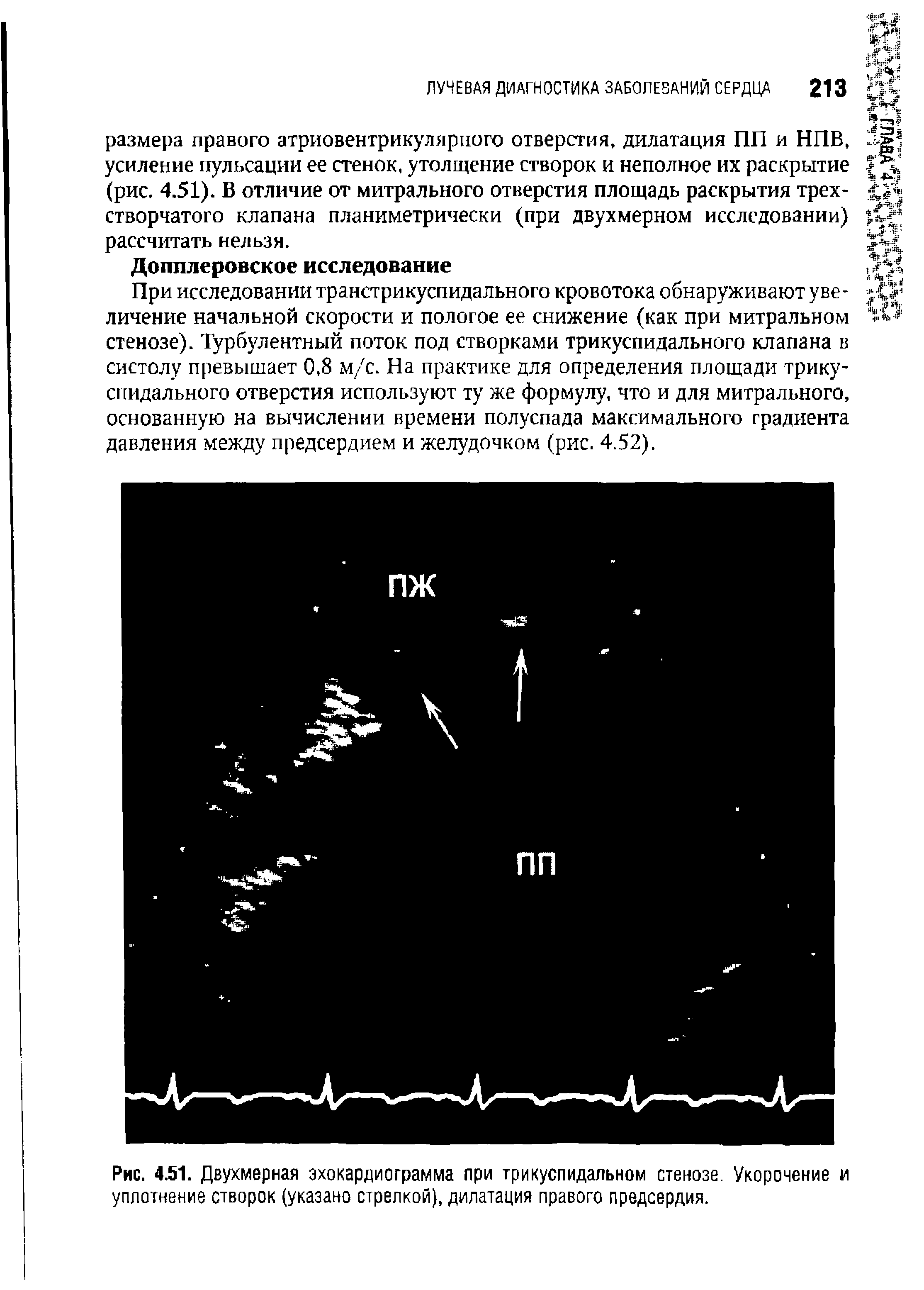 Рис. 4.51. Двухмерная эхокардиограмма при трикуспидальном стенозе. Укорочение и уплотнение створок (указано стрелкой), дилатация правого предсердия.