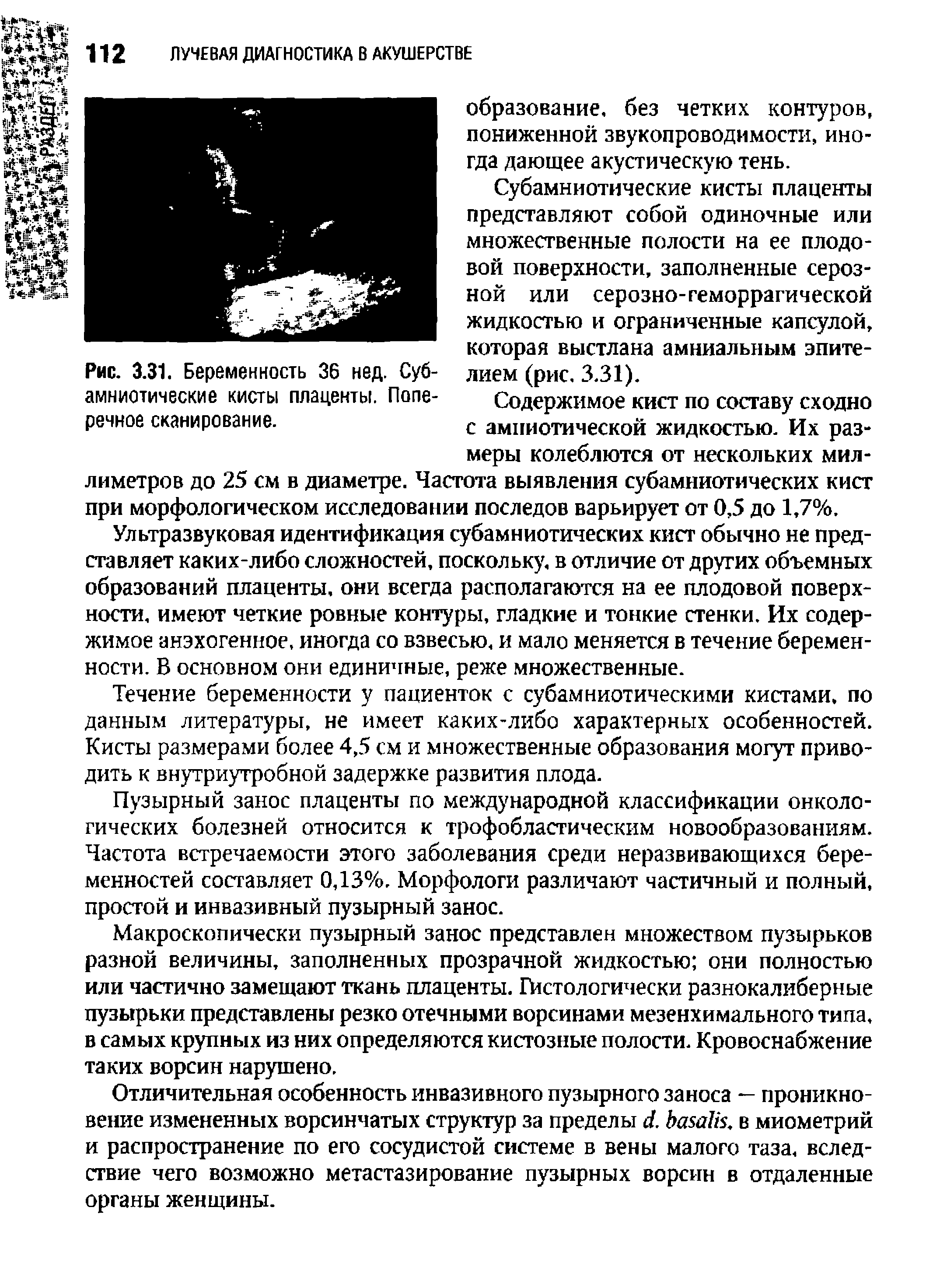 Рис. 3.31. Беременность 36 нед. Субамниотические кисты плаценты. Поперечное сканирование.