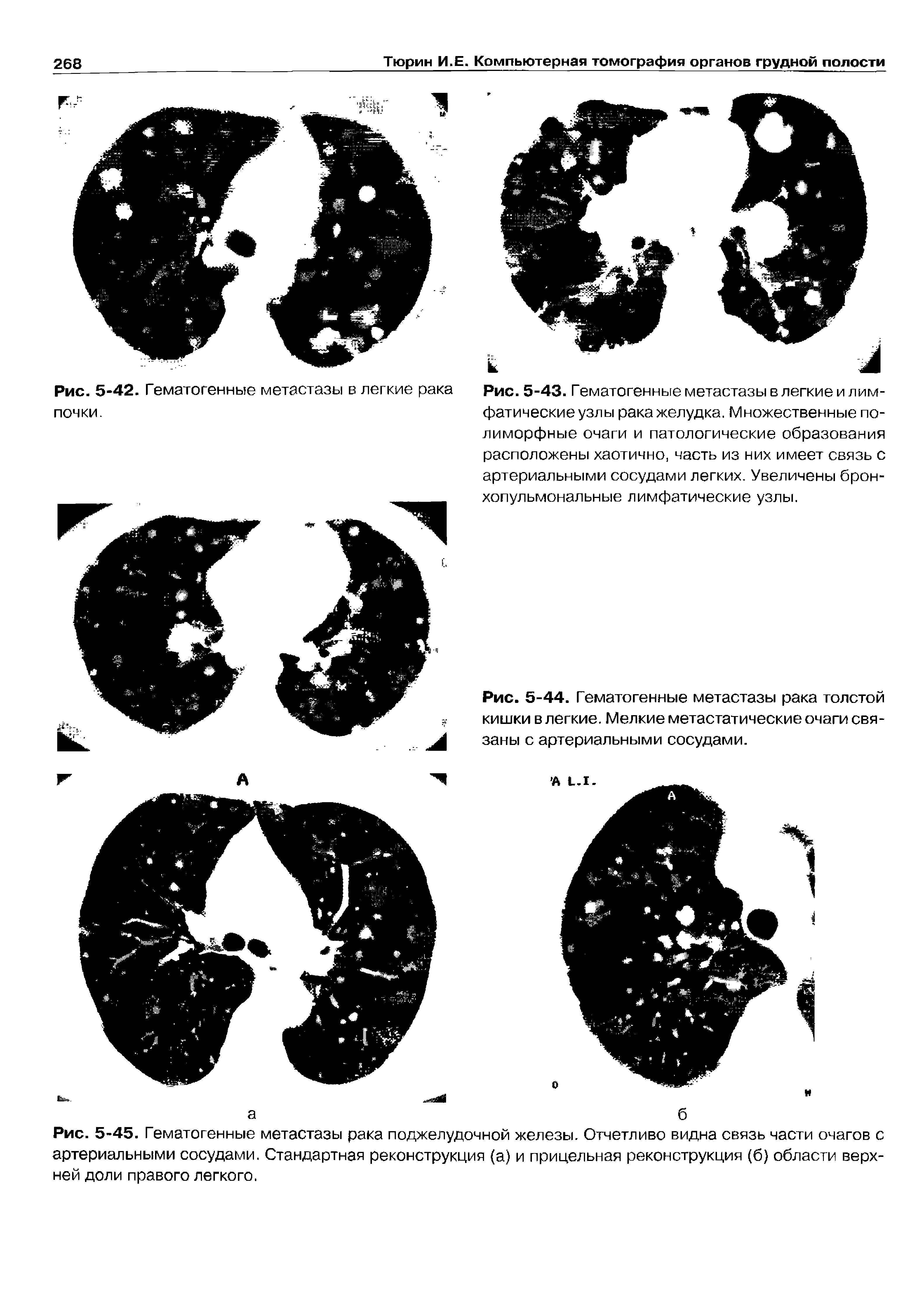 Рис. 5-43. Гематогенные метастазы в легкие и лимфатические узлы рака желудка. Множественные полиморфные очаги и патологические образования расположены хаотично, часть из них имеет связь с артериальными сосудами легких. Увеличены бронхопульмональные лимфатические узлы.