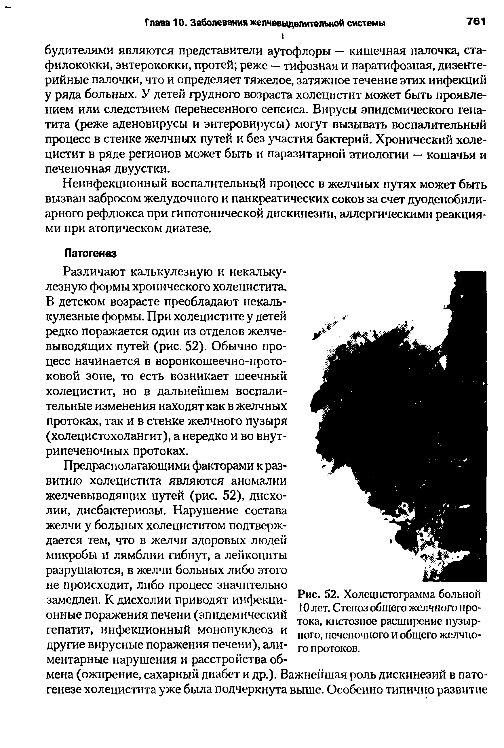 Рис. 52. Холсцпстограмма больной 10 лет. Стеноз общего желчного протока, кистозное расширение пузырного, печеночного и общего желчного протоков.