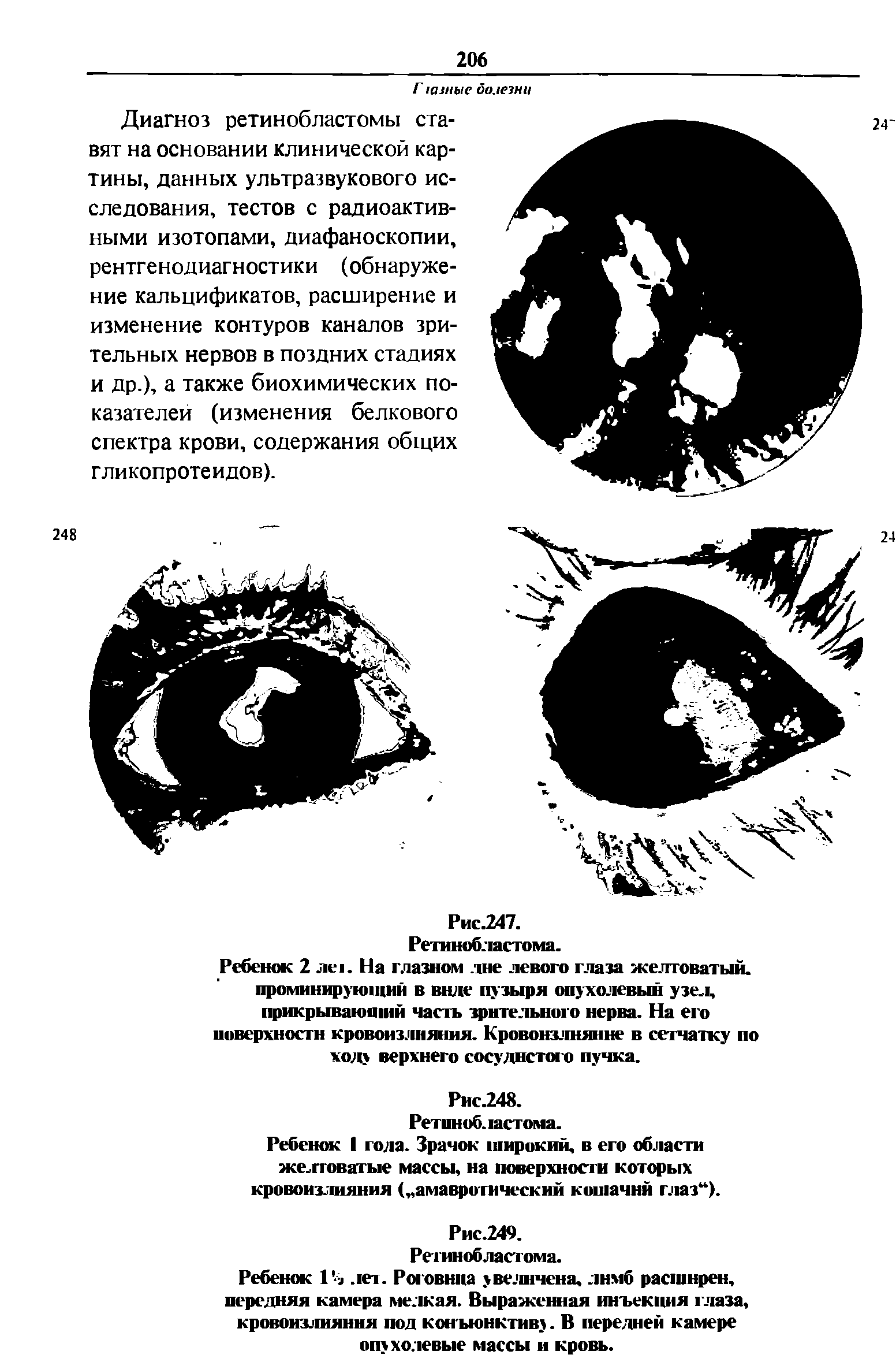Рис.247. Ретинобластома. Ребенок 2 леи На глазном лне левого глаза желтоватый, проминирутощий в виде пузыря опухолевый узел, прикрывающий часть зрительного нерва. На его поверхности кровоизлияния. Кровоизлияние в сетчатку по ходу верхнего сосудистого пучка.