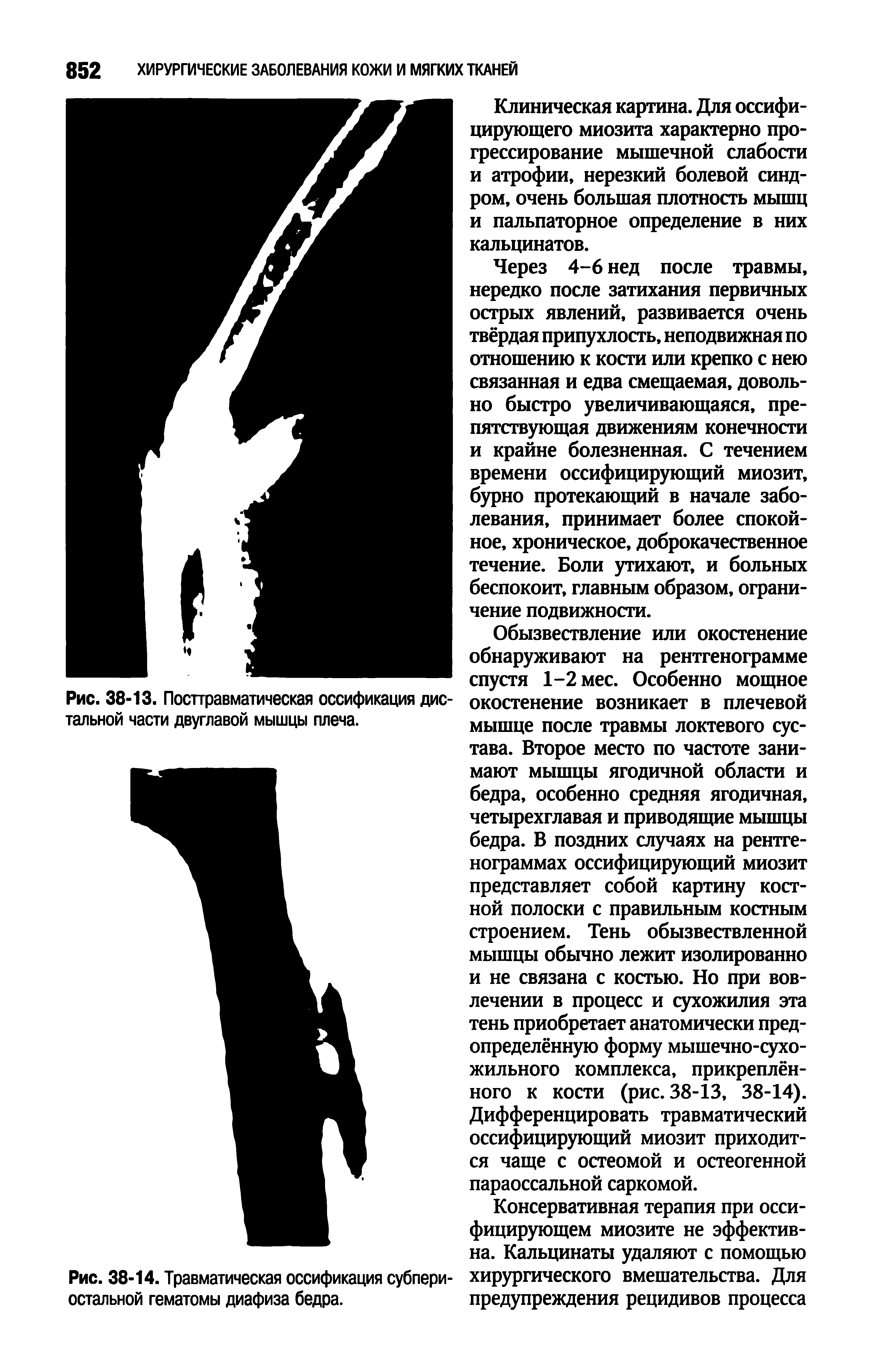 Рис. 38-14. Травматическая оссификация субпериостальной гематомы диафиза бедра.