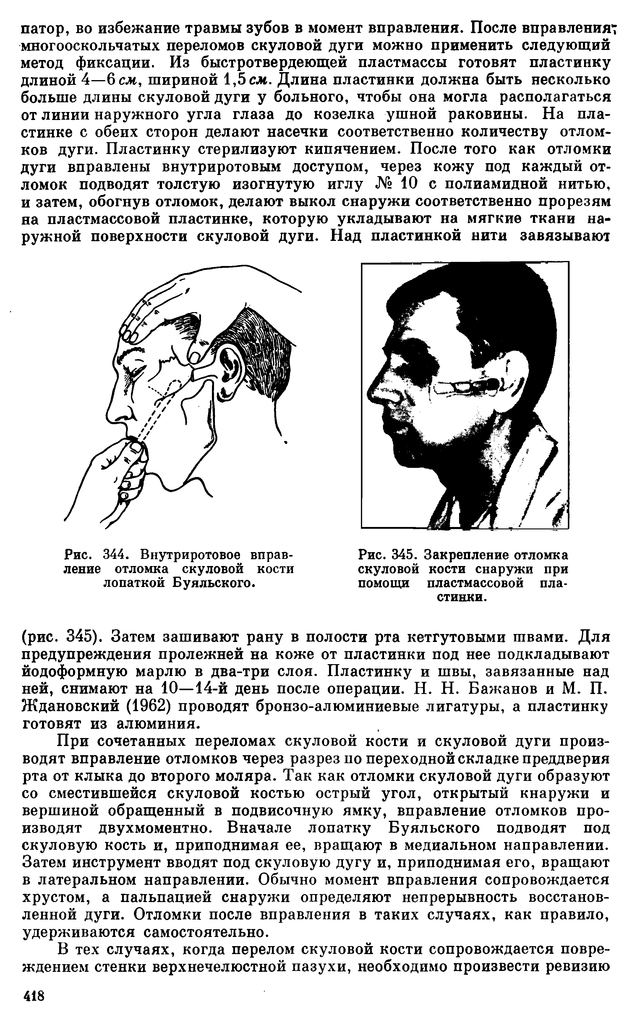 Рис. 344. Внутриротовое вправление отломка скуловой кости лопаткой Буяльского.