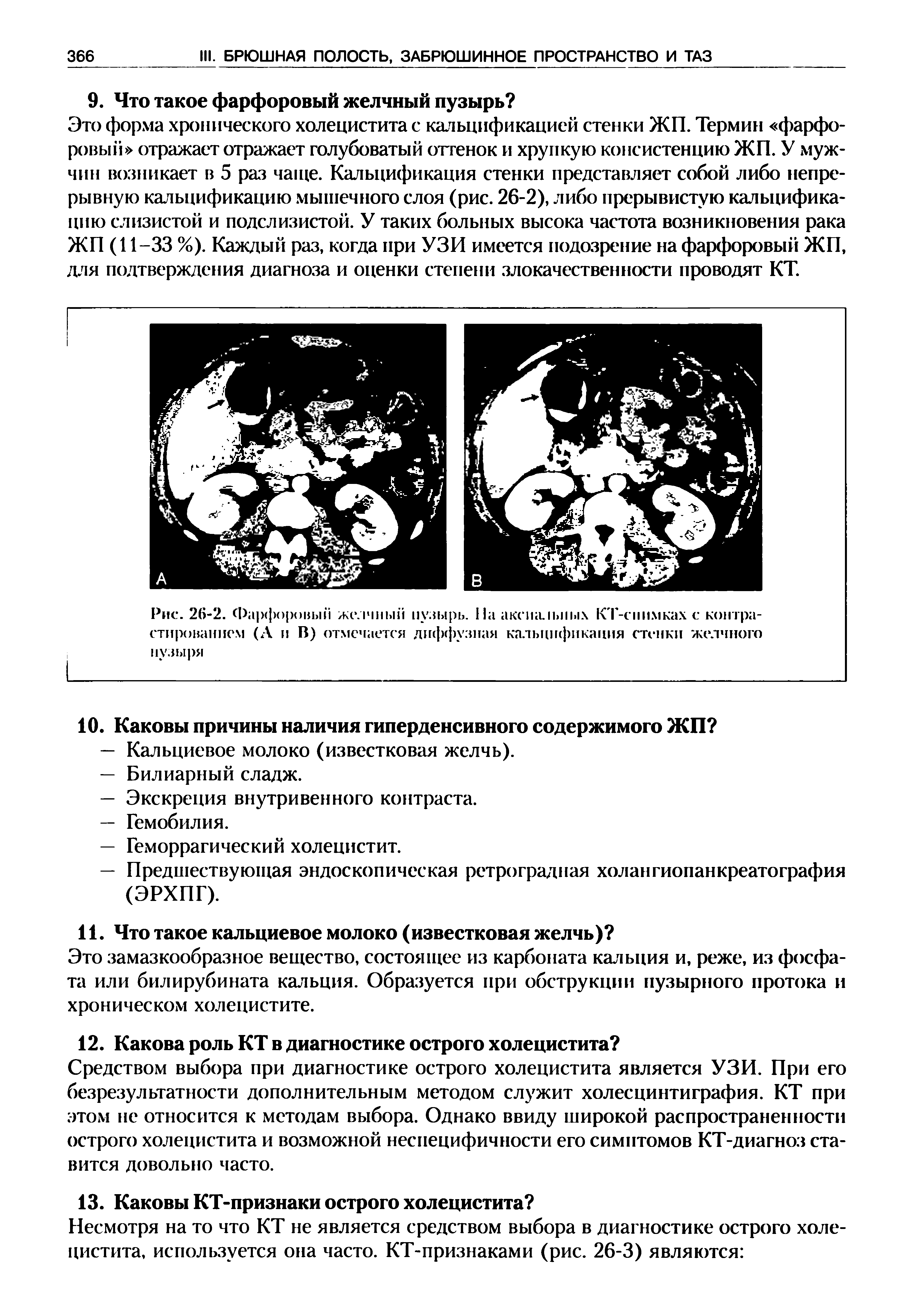 Рис. 26-2. Фарфоровый желчный пузырь. На аксиальных КТ-снимках с контрастированием (А и В) отмечается диффузная кальцификация стенки желчного пузыря...