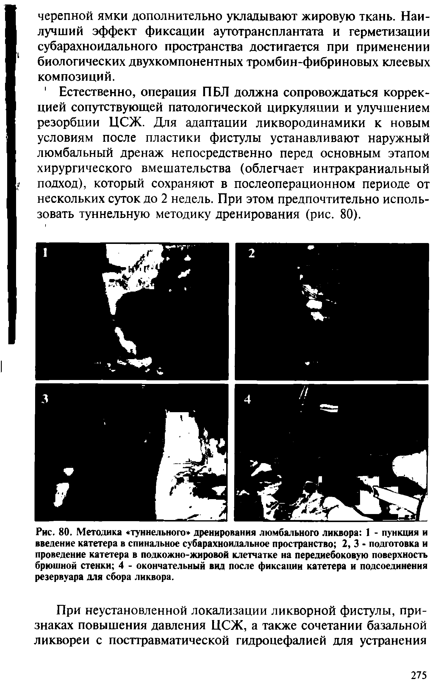 Рис. 80. Методика туннельного дренирования люмбального ликвора 1 - пункция и введение катетера в спинальное субарахноидальное пространство 2, 3 - подготовка и проведение катетера в подкожно-жировой клетчатке на переднебоковую поверхность брюшной стенки 4 - окончательный вид после фиксации катетера и подсоединения резервуара для сбора ликвора.