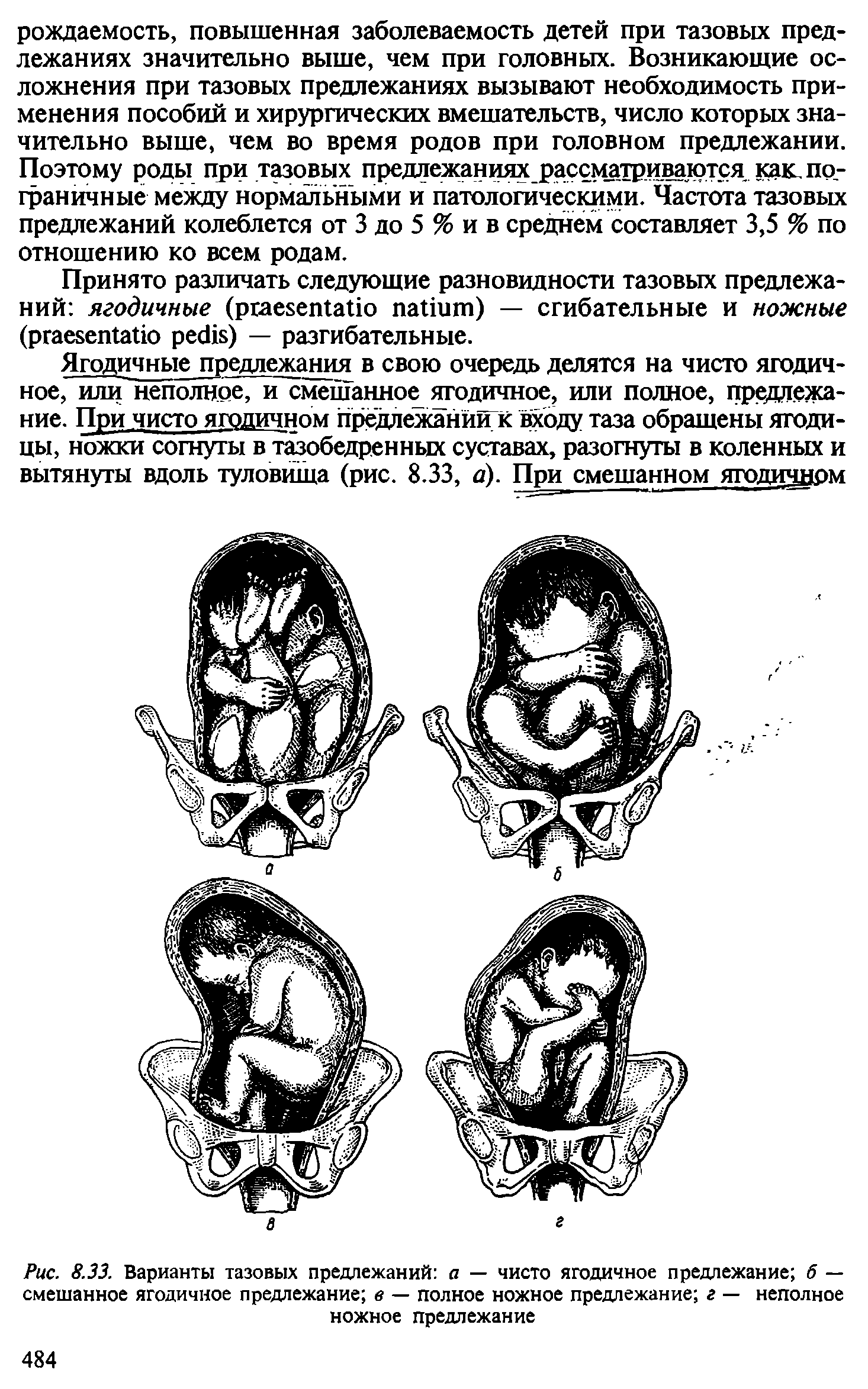 Рис. 8.33. Варианты тазовых предлежаний а — чисто ягодичное предлежание б — смешанное ягодичное предлежание в — полное ножное предлежание г — неполное ножное предлежание...