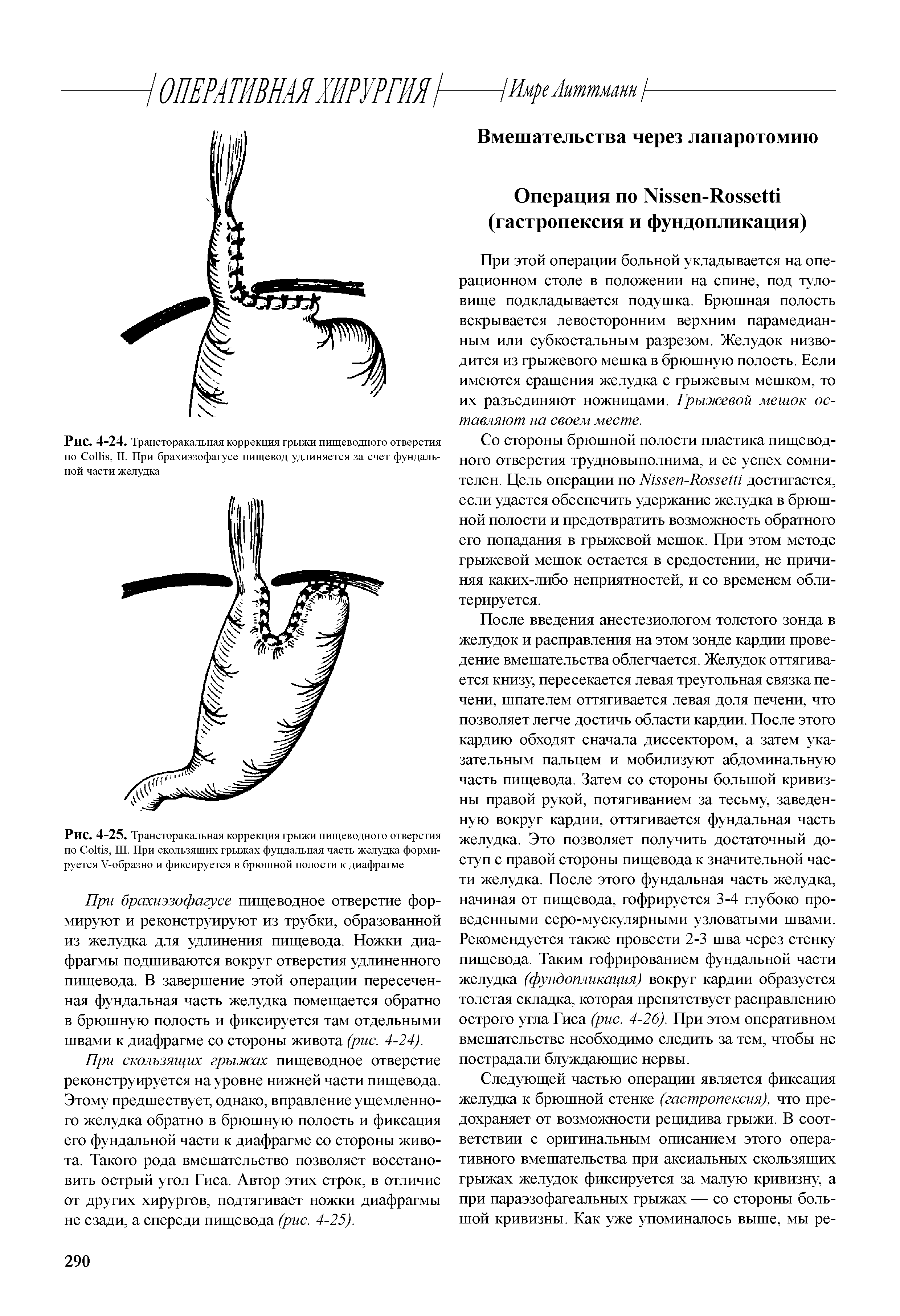 Рис. 4-24. Трансторакальная коррекция грыжи пищеводного отверстия по C , II. При брахиэзофагусе пищевод удлиняется за счет фундальной части желудка...