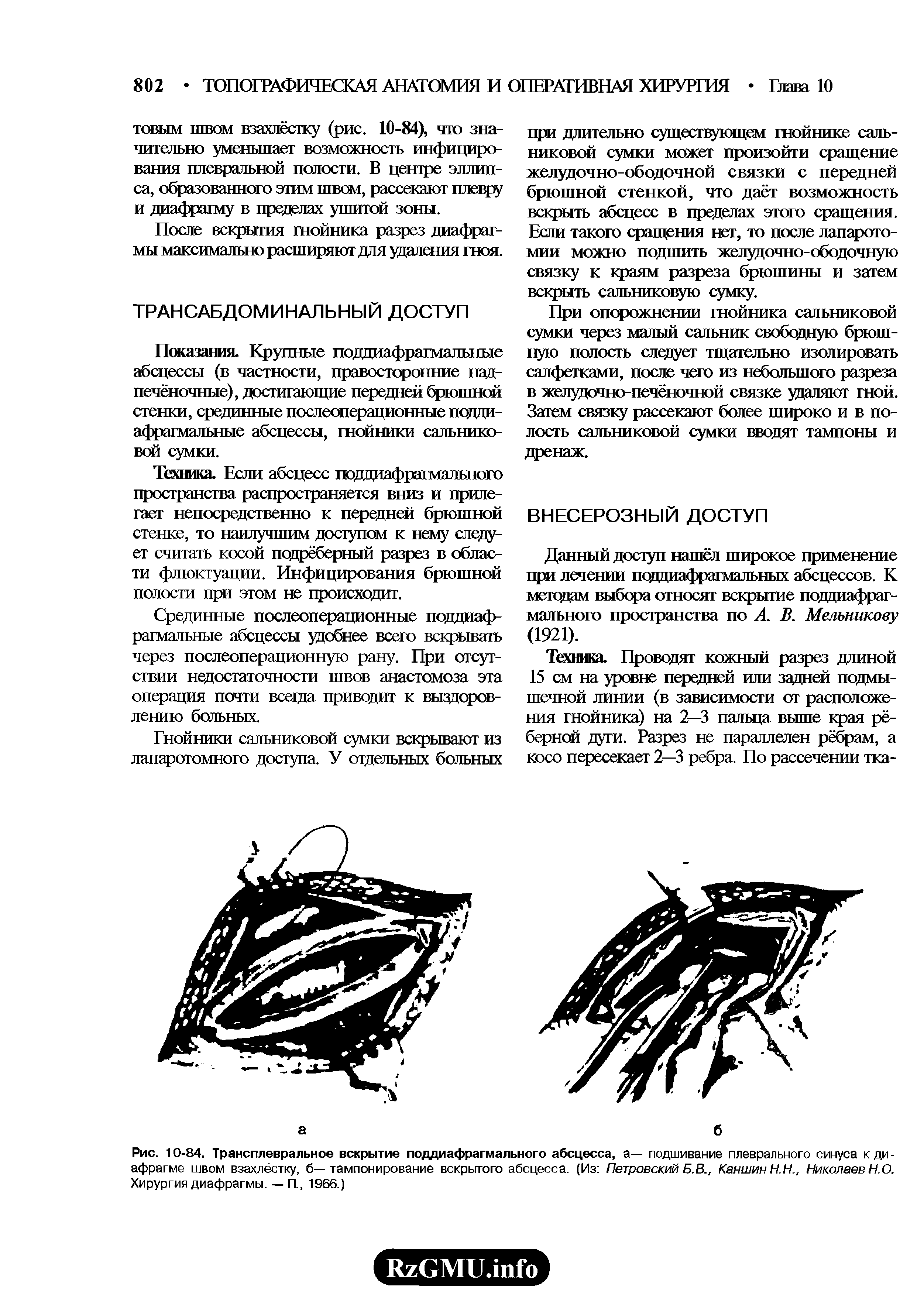 Рис. 10-84. Трансплевральное вскрытие поддиафрагмального абсцесса, а— подшивание плеврального синуса к диафрагме швом взахлёстку, б— тампонирование вскрытого абсцесса. (Из Петровский Б.В., Каншин Н.Н., Николаев Н.О. Хирургия диафрагмы. — П., 1966.)...