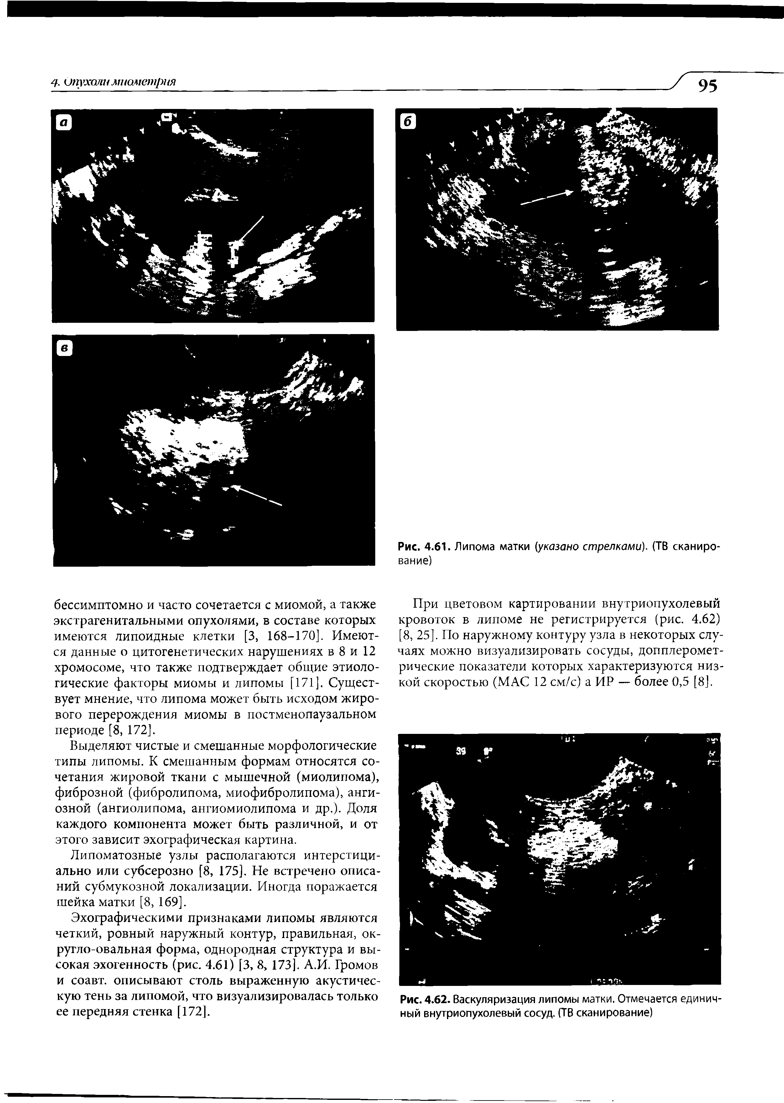 Рис. 4.62. Васкуляризация липомы матки. Отмечается единичный внутриопухолевый сосуд. (ТВ сканирование)...