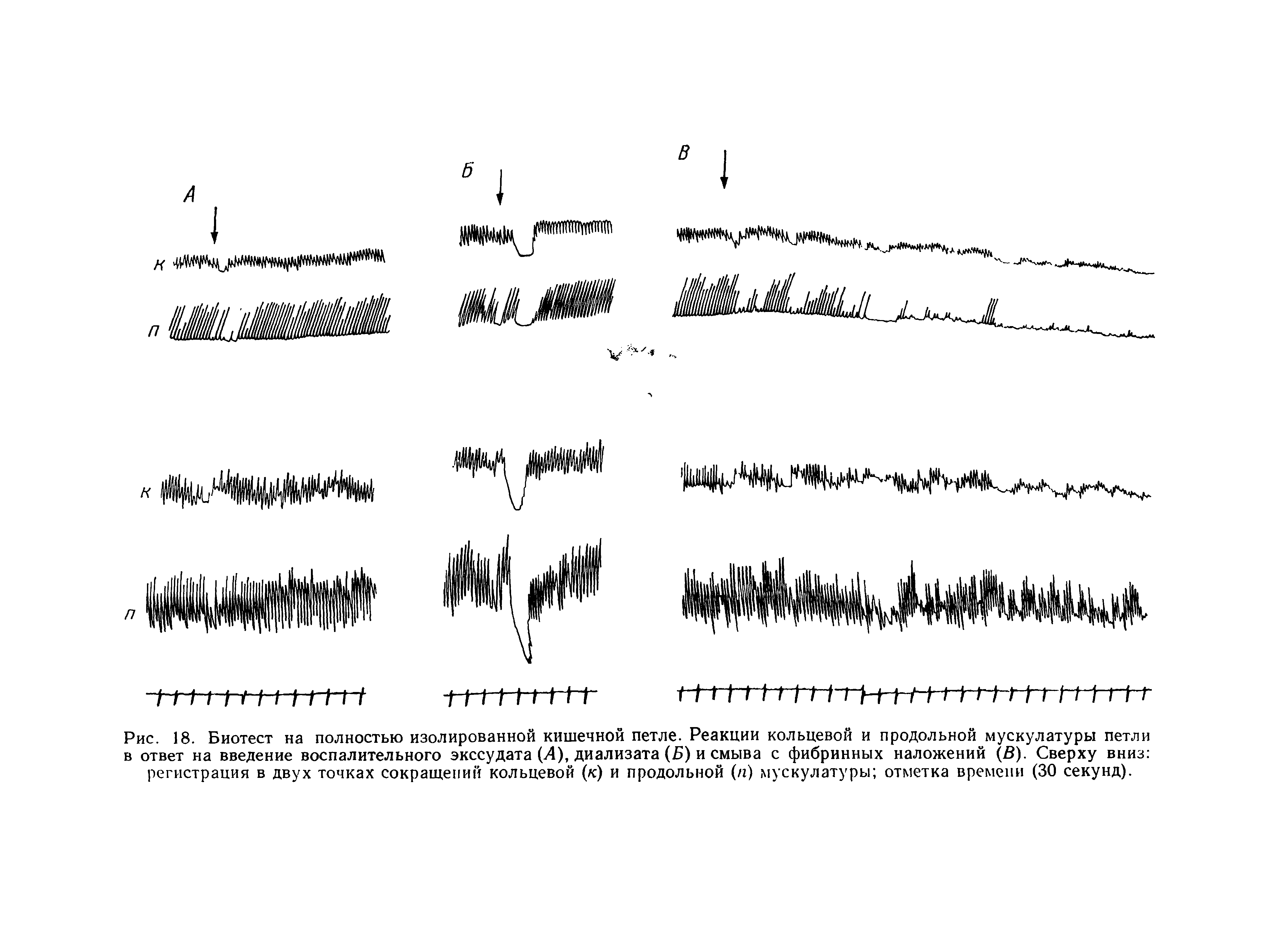 Рис. 18. Биотест на полностью изолированной кишечной петле. Реакции кольцевой и продольной мускулатуры петли в ответ на введение воспалительного экссудата (4), диализата (Б) и смыва с фибринных наложений (В). Сверху вниз регистрация в двух точках сокращений кольцевой (к) и продольной (/г) мускулатуры отметка времени (30 секунд).