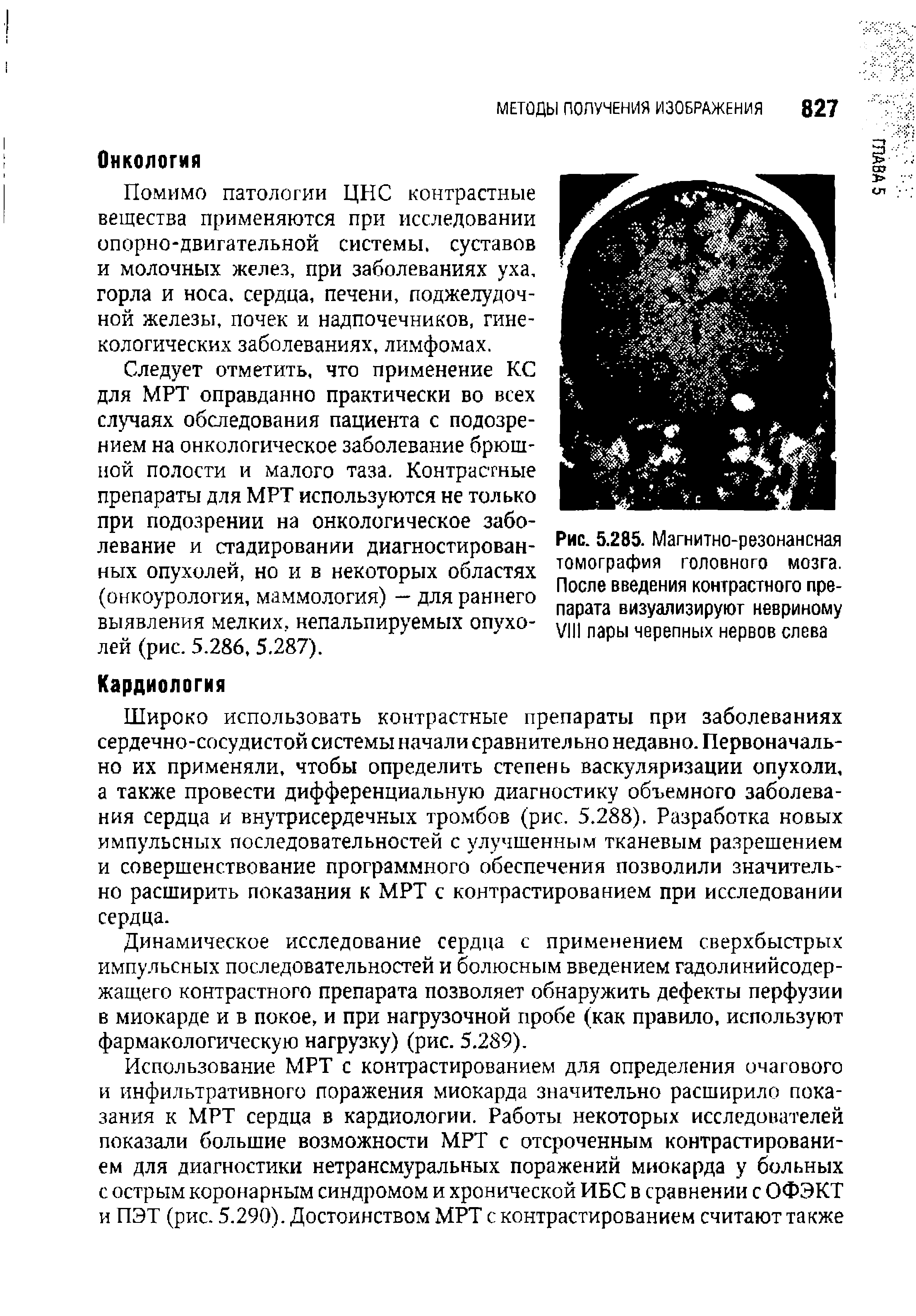 Рис. 5.285. Магнитно-резонансная томография головного мозга. После введения контрастного препарата визуализируют невриному VIII пары черепных нервов слева...