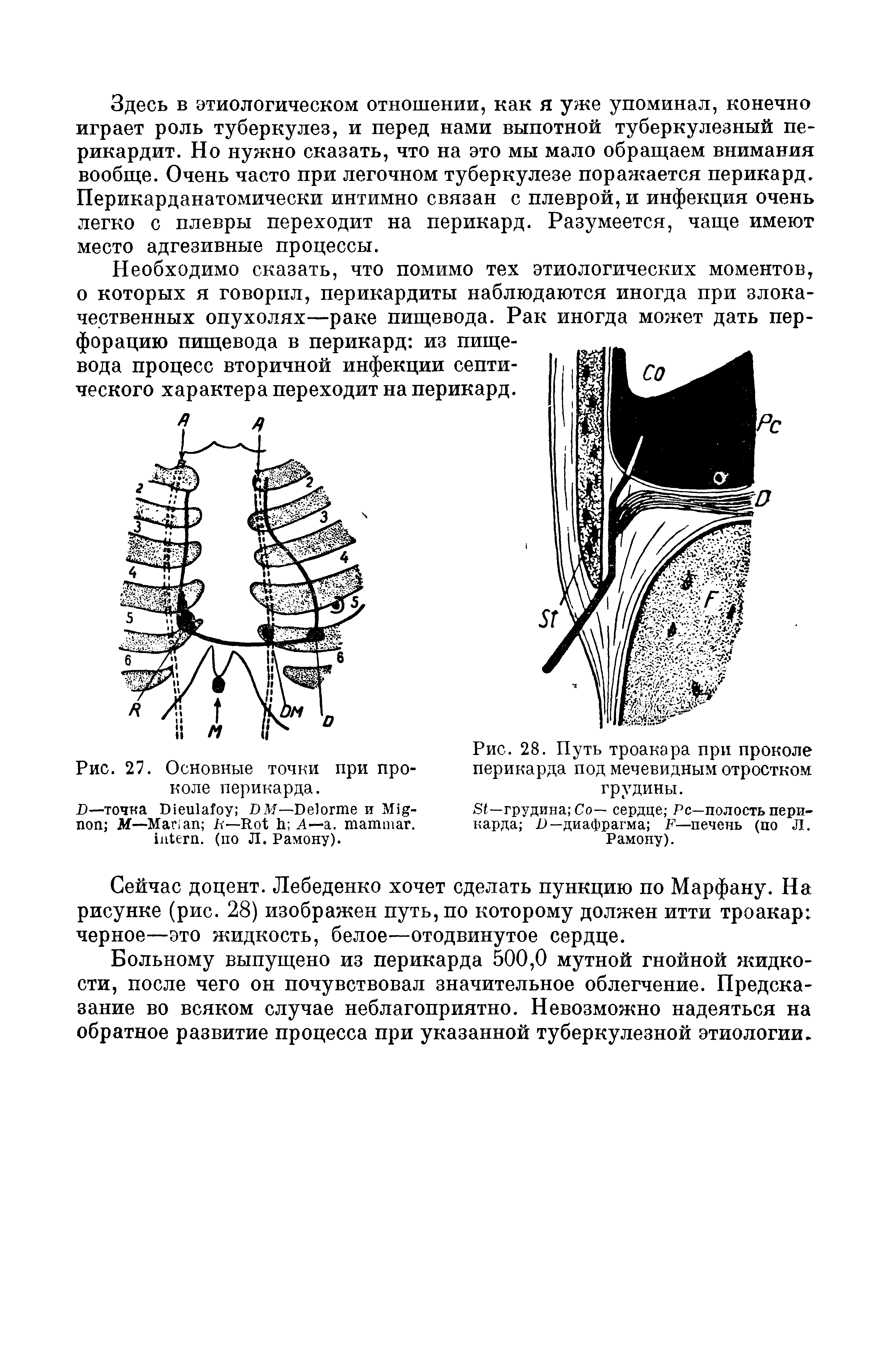 Рис. 28. Путь троакара при проколе перикарда под мечевидным отростком грудины.