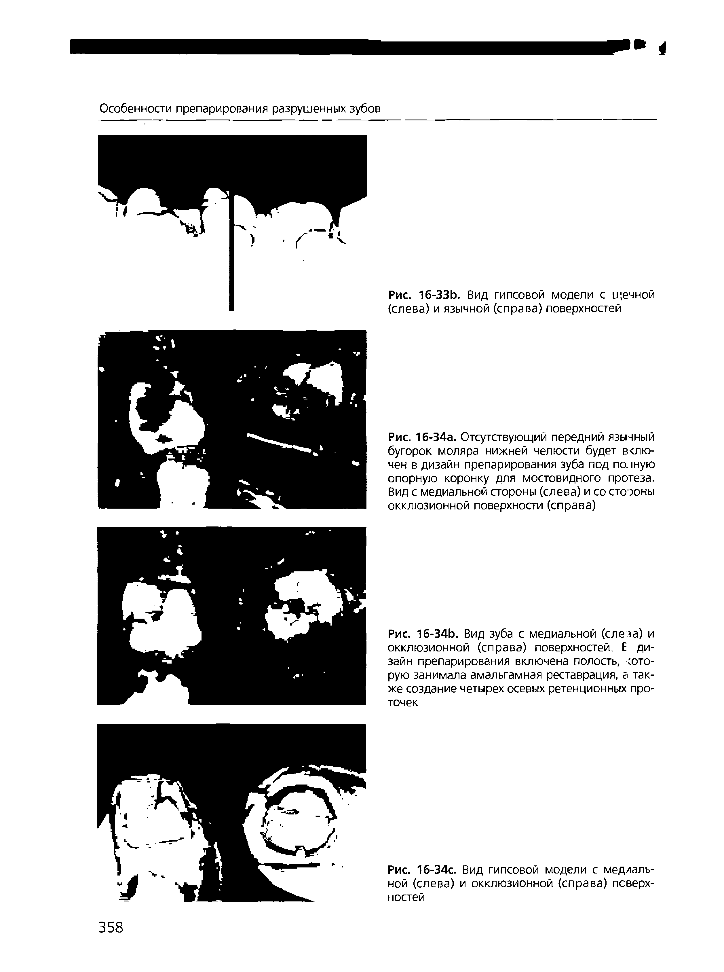 Рис. 16-34а. Отсутствующий передний язычный бугорок моляра нижней челюсти будет включен в дизайн препарирования зуба под полную опорную коронку для мостовидного протеза. Вид с медиальной стороны (слева) и со стоэоны окклюзионной поверхности (справа)...