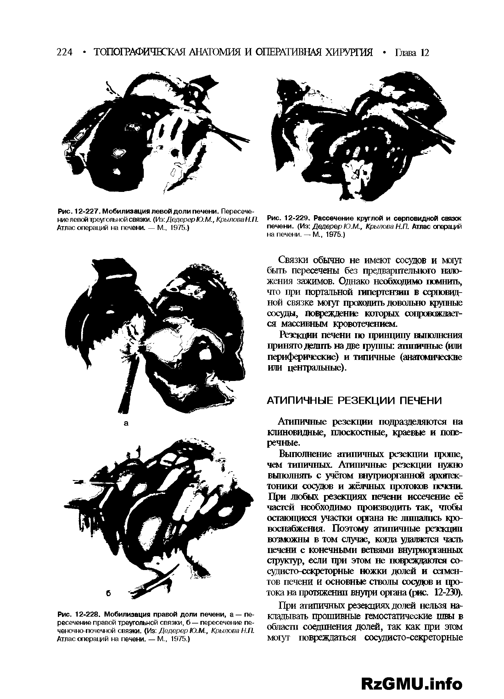 Рис. 12-227. Мобилизация левой доли печени. Пересечение левой треугольной связки. (у з.ДедерерЮ.М., КрыловаН.П. Атлас операций на печени. — М 1975.)...