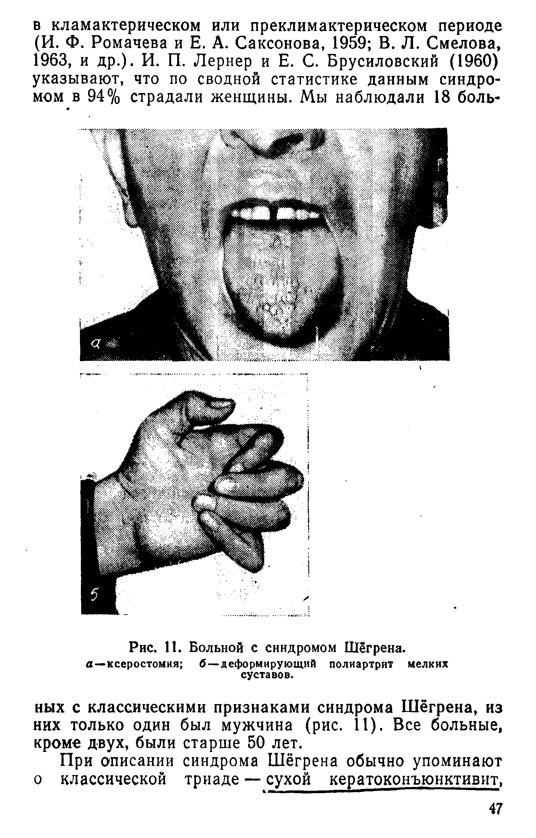 Рис. 11. Больной с синдромом Шегрена, а—ксеростомия б—деформирующий полиартрит мелких суставов.