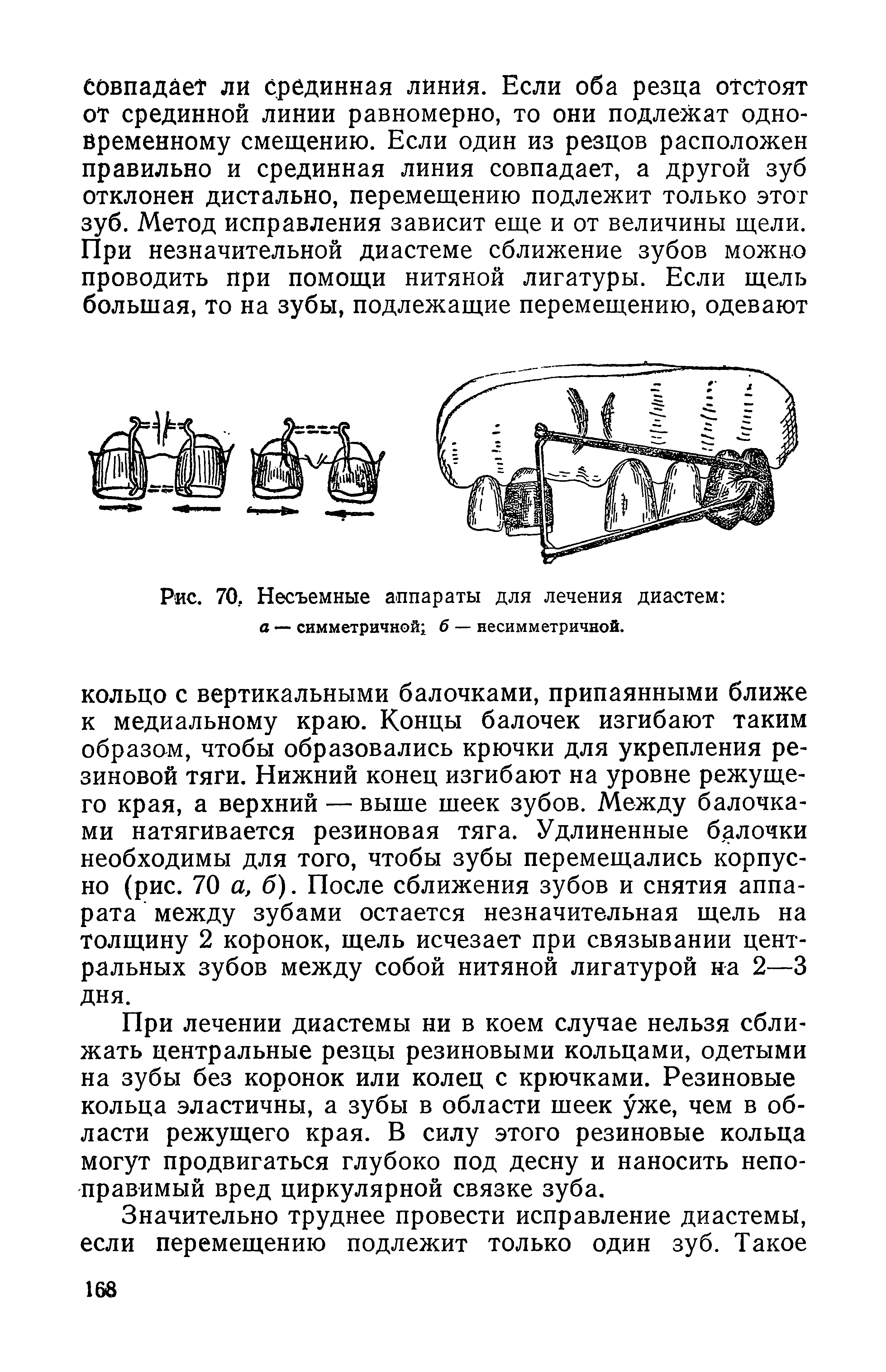 Рис. 70. Несъемные аппараты для лечения диастем а — симметричной б — несимметричной.