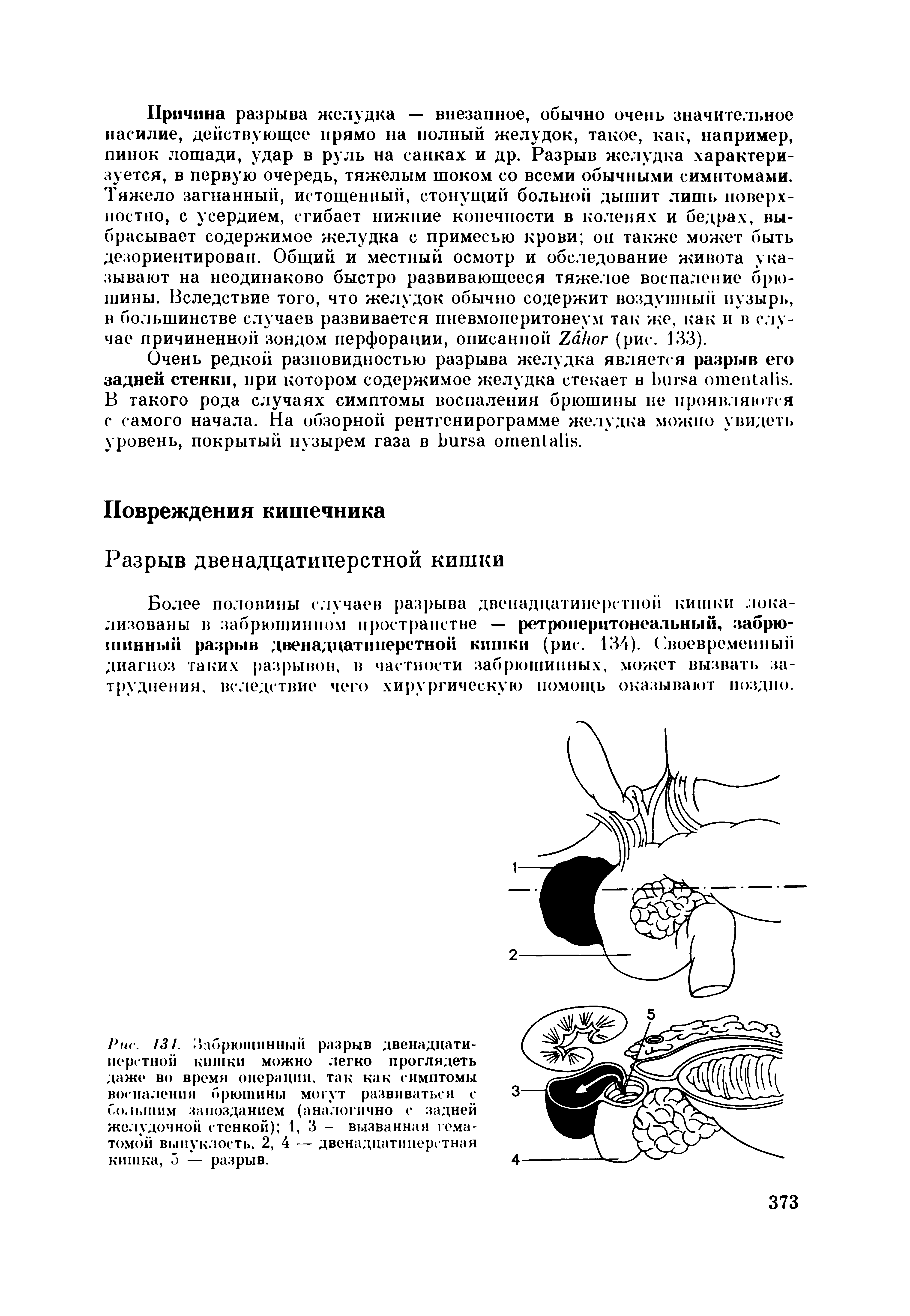 Рис. 134. Забрюшинный разрыв двенадцатиперстной кишки можно легко проглядеть даже во время операции, так как симптомы воспаления брюшины могут развиваться с большим запозданием (аналогично с задней желудочной стенкой) 1,3- вызванная гематомой выпуклость, 2, 4 — двенадцатиперстная кишка, 3 — разрыв.