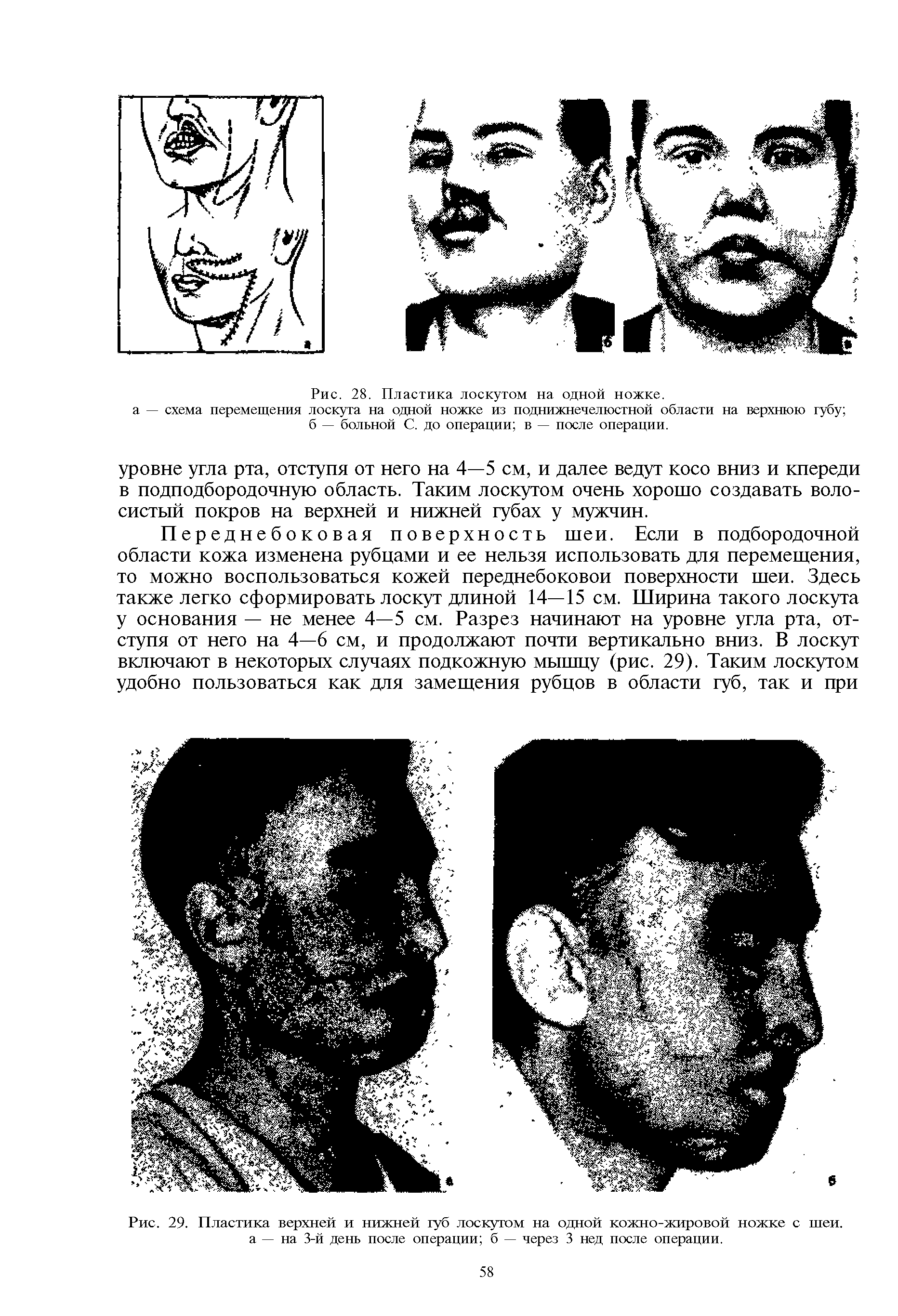 Рис. 29. Пластика верхней и нижней губ лоскутом на одной кожно-жировой ножке с шеи. а — на 3-й день после операции б — через 3 нед после операции.