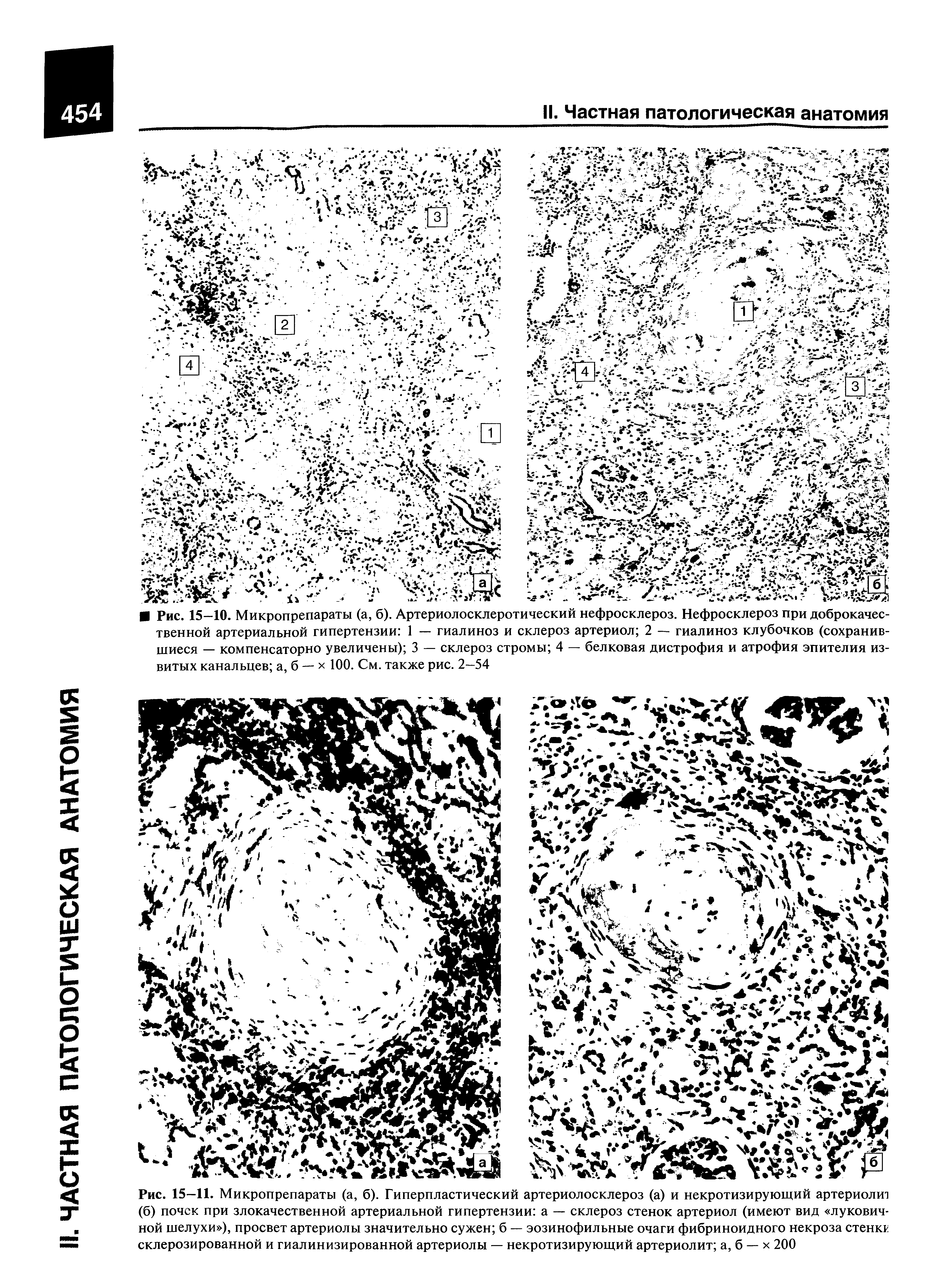 Рис. 15—11. Микропрепараты (а, б). Гиперпластический артериолосклероз (а) и некротизирующий артериолит (б) почек при злокачественной артериальной гипертензии а — склероз стенок артериол (имеют вид луковичной шелухи ), просвет артериолы значительно сужен б — эозинофильные очаги фибриноидного некроза стенкг склерозированной и гиалинизированной артериолы — некротизирующий артериолит а, б — х 200...