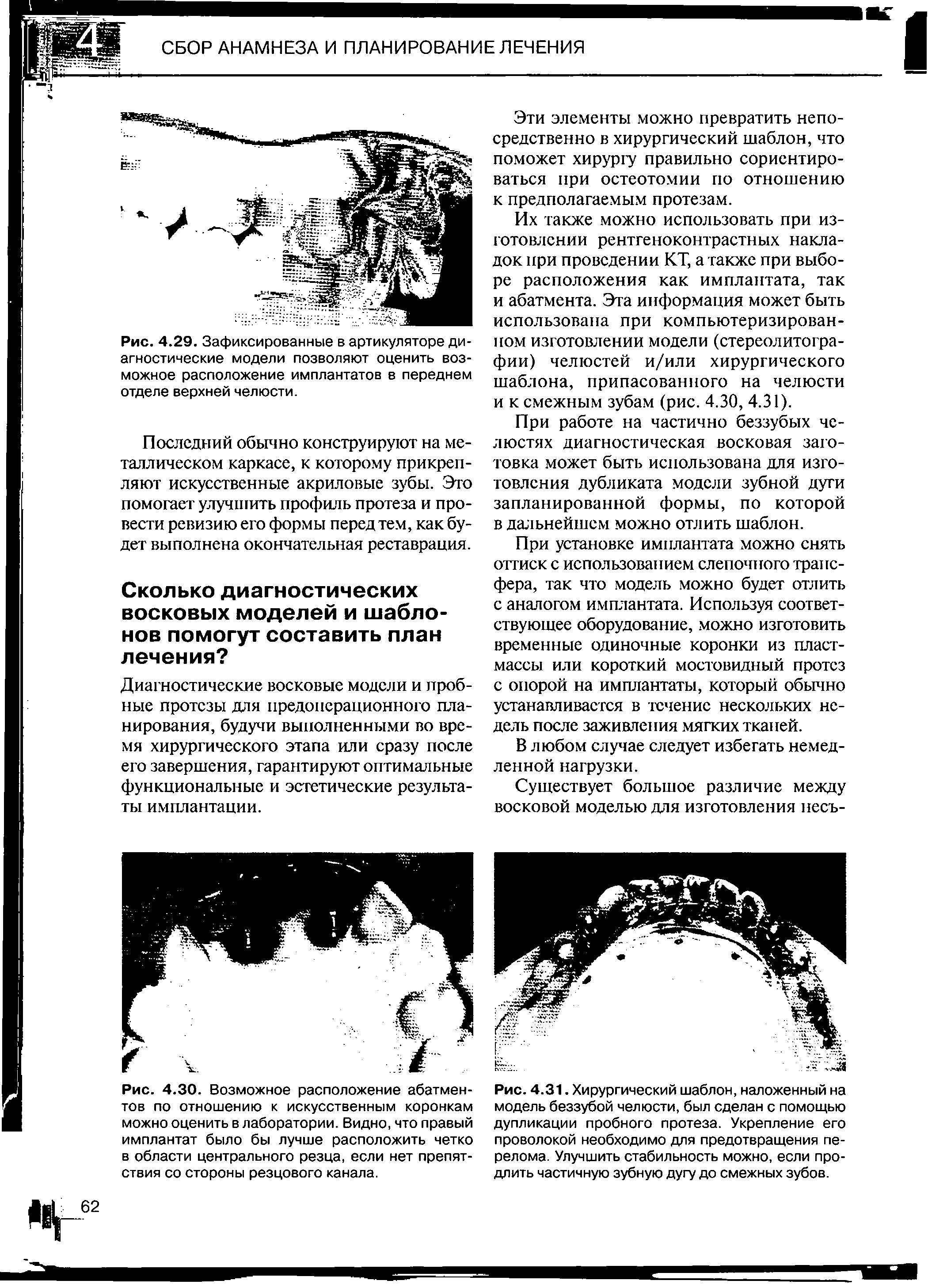 Рис. 4.31. Хирургический шаблон, наложенный на модель беззубой челюсти, был сделан с помощью дупликации пробного протеза. Укрепление его проволокой необходимо для предотвращения перелома. Улучшить стабильность можно, если продлить частичную зубную дугу до смежных зубов.