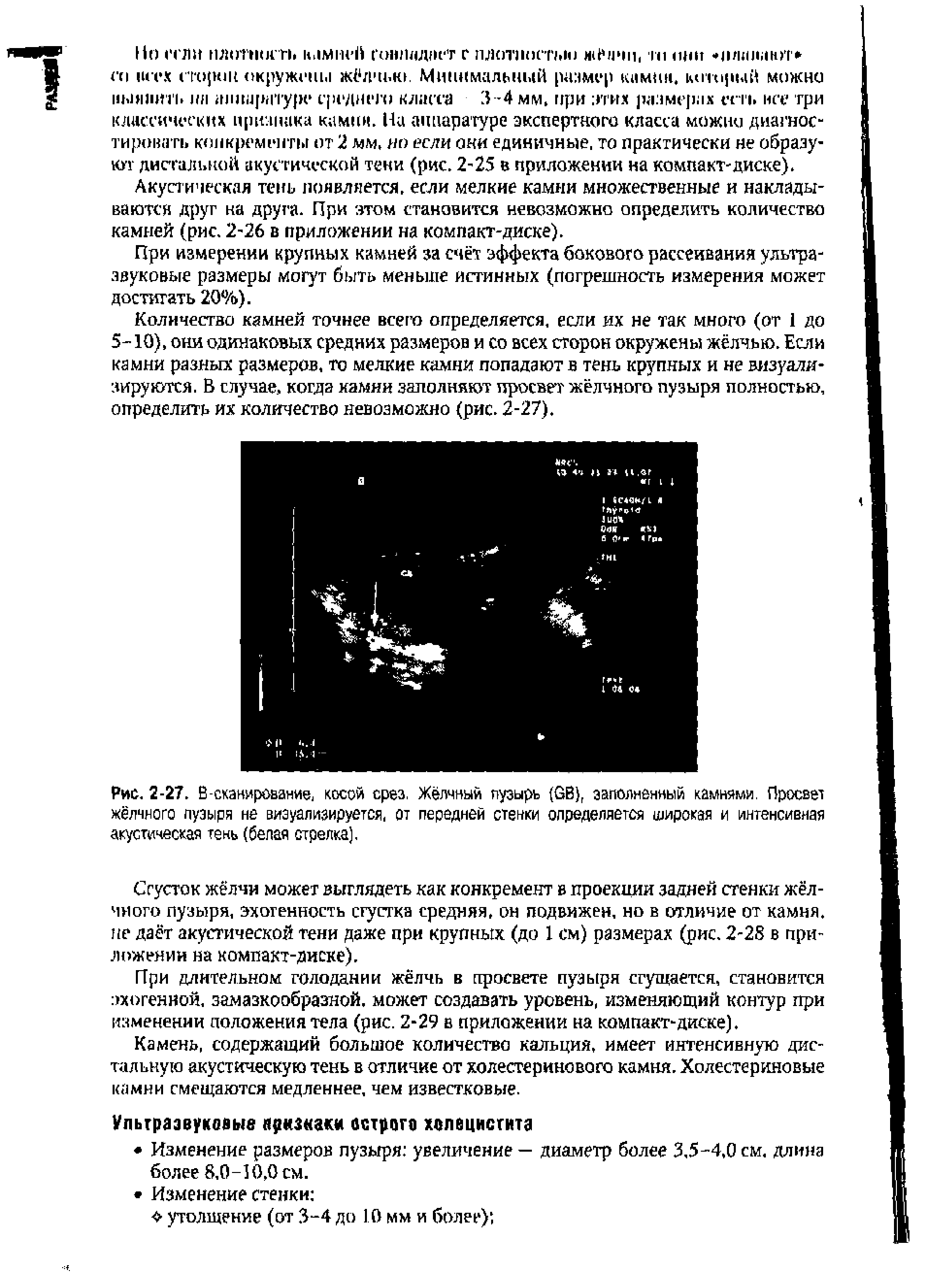 Рис. 2-27. В-сканирование, косой срез, Жёлчный пузырь (СВ), заполненный камнями. Просвет жёлчного пузыря не визуализируется, от передней стенки определяется широкая и интенсивная акустическая тень (белая стрелка).