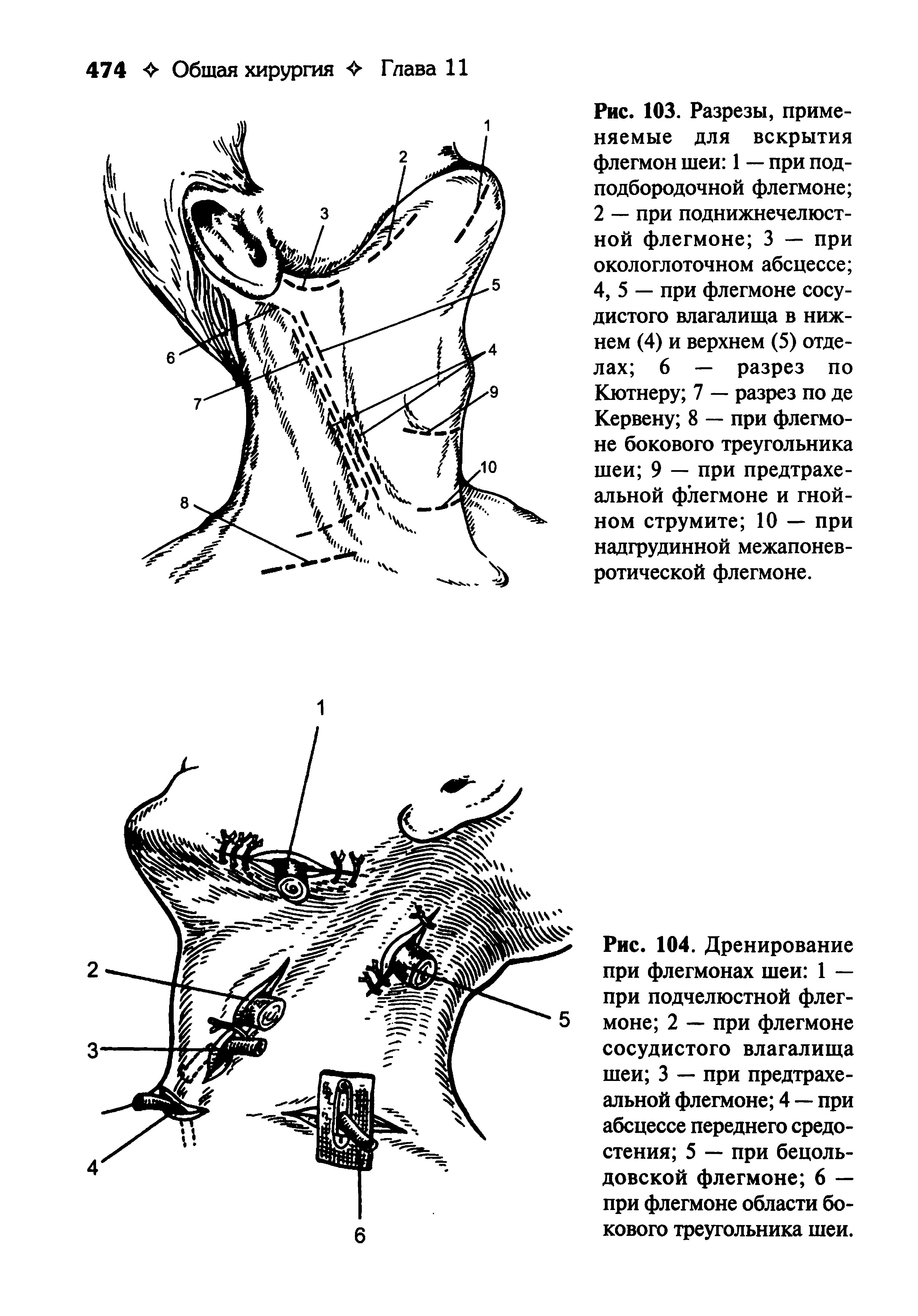 Рис. 104. Дренирование при флегмонах шеи 1 — при подчелюстной флегмоне 2 — при флегмоне сосудистого влагалища шеи 3 — при предтрахе-альной флегмоне 4 — при абсцессе переднего средостения 5 — при бецоль-довской флегмоне 6 — при флегмоне области бокового треугольника шеи.