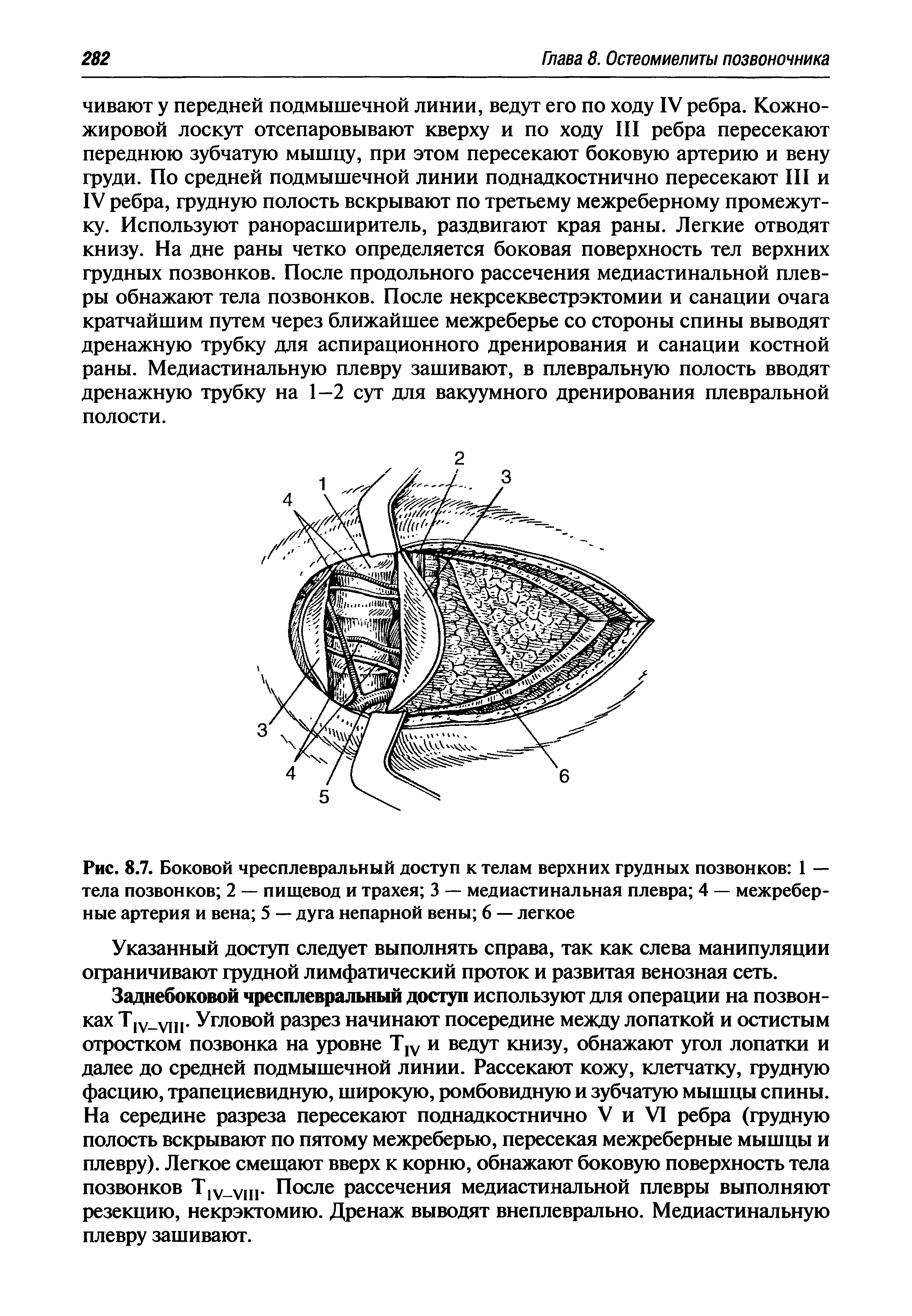 Рис. 8.7. Боковой чресплевральный доступ к телам верхних грудных позвонков 1 — тела позвонков 2 — пищевод и трахея 3 — медиастинальная плевра 4 — межреберные артерия и вена 5 — дуга непарной вены 6 — легкое...