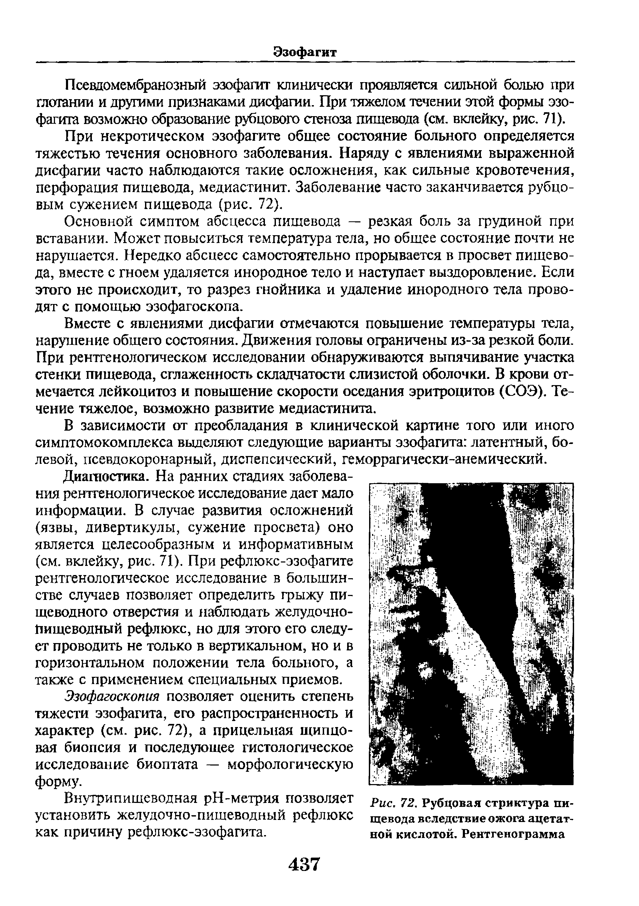 Рис. 72. Рубцовая стриктура пищевода вследствие ожога ацетатной кислотой. Рентгенограмма...