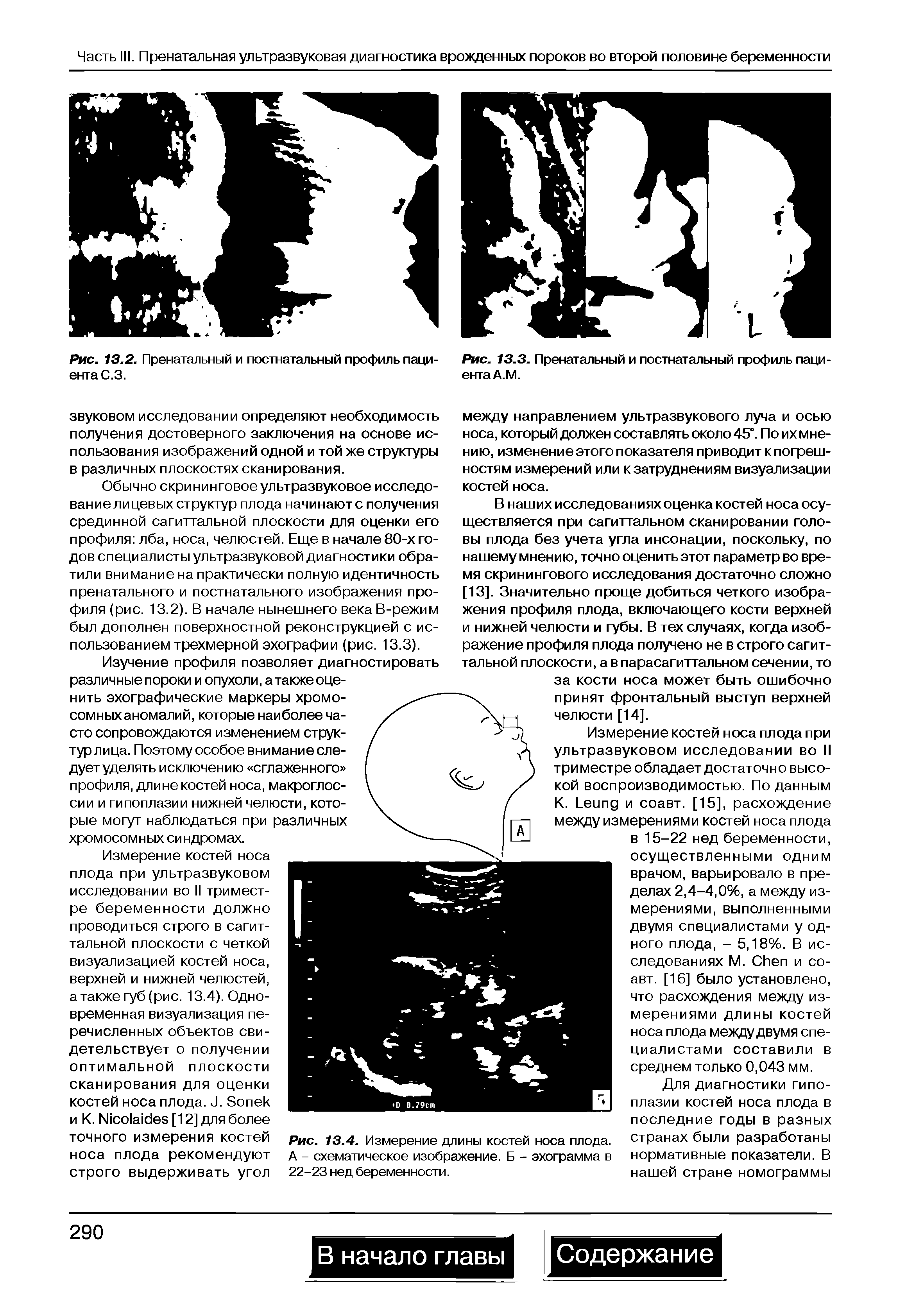 Рис. 13.4. Измерение длины костей носа плода. А - схематическое изображение. Б - эхограмма в 22-23 нед беременности.