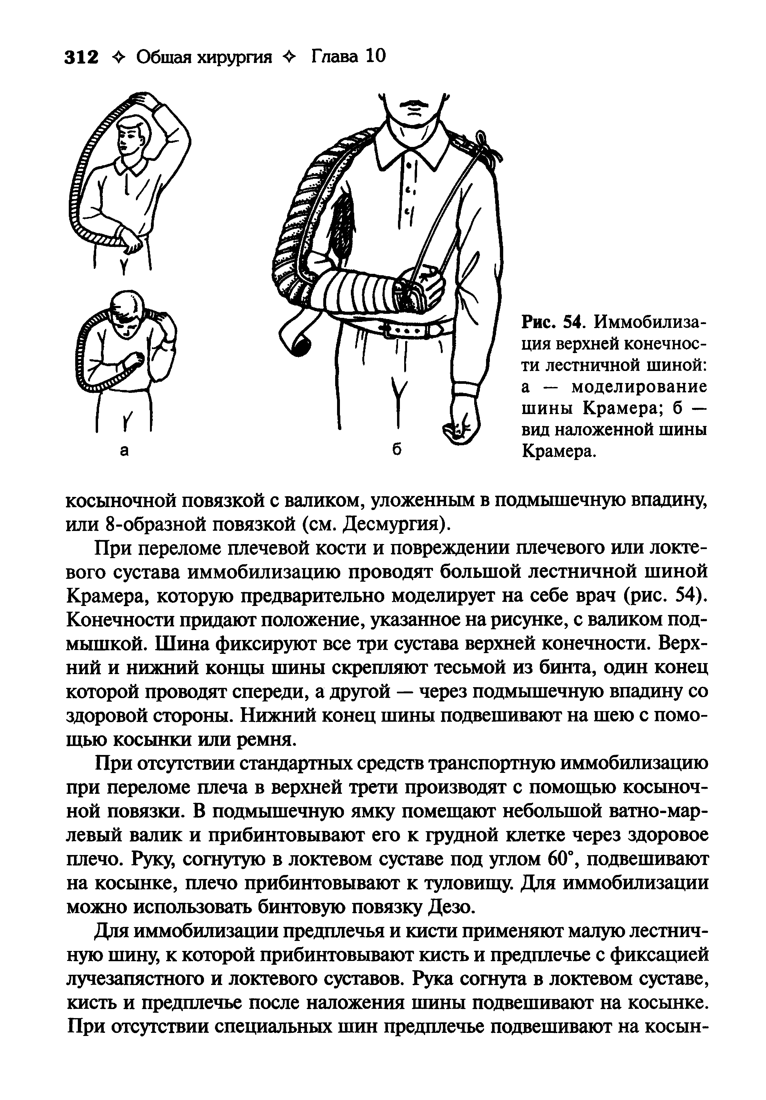 Рис. 54. Иммобилизация верхней конечности лестничной шиной а — моделирование шины Крамера б — вид наложенной шины Крамера.