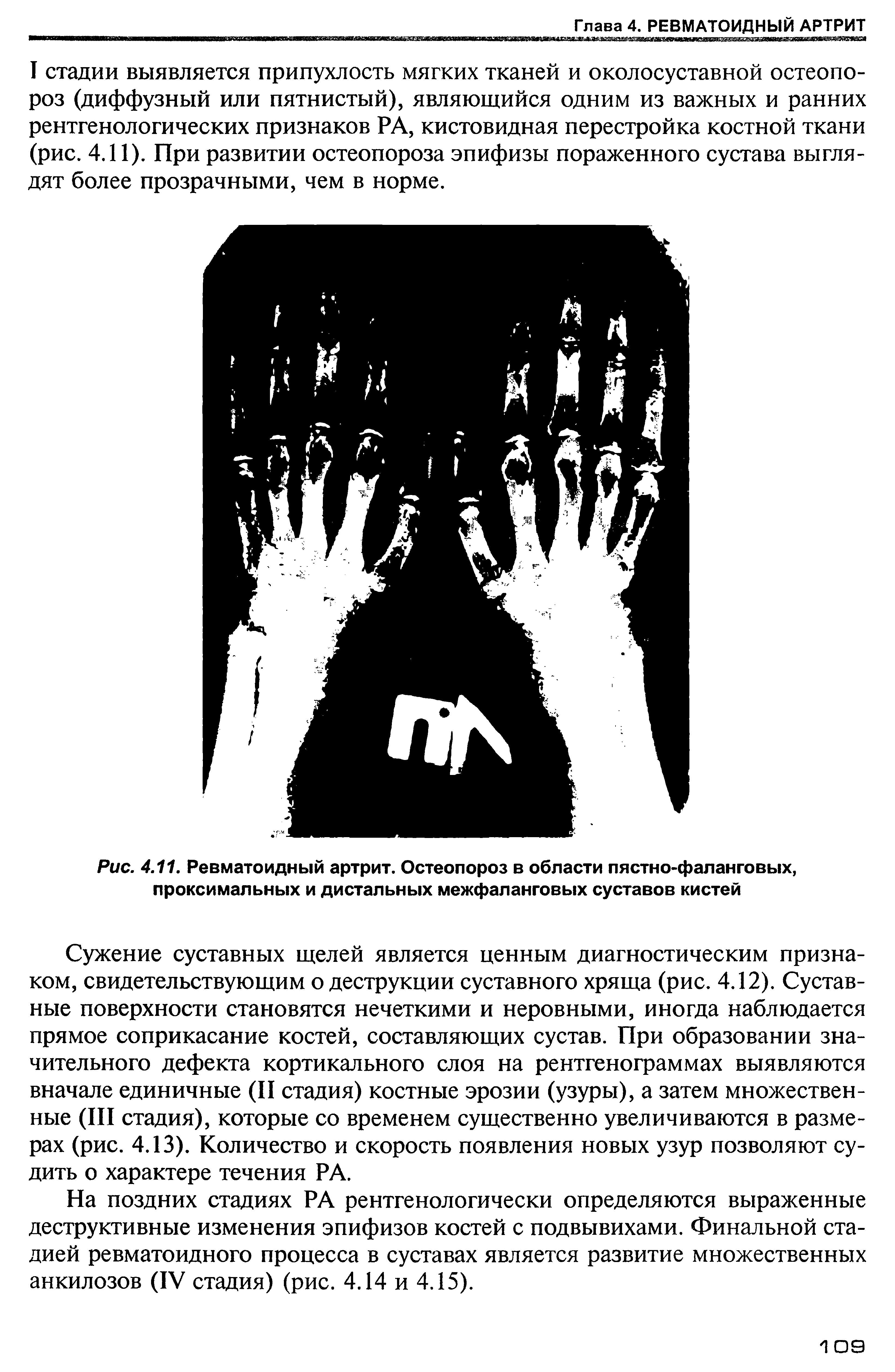 Рис. 4.11. Ревматоидный артрит. Остеопороз в области пястно-фаланговых, проксимальных и дистальных межфаланговых суставов кистей...