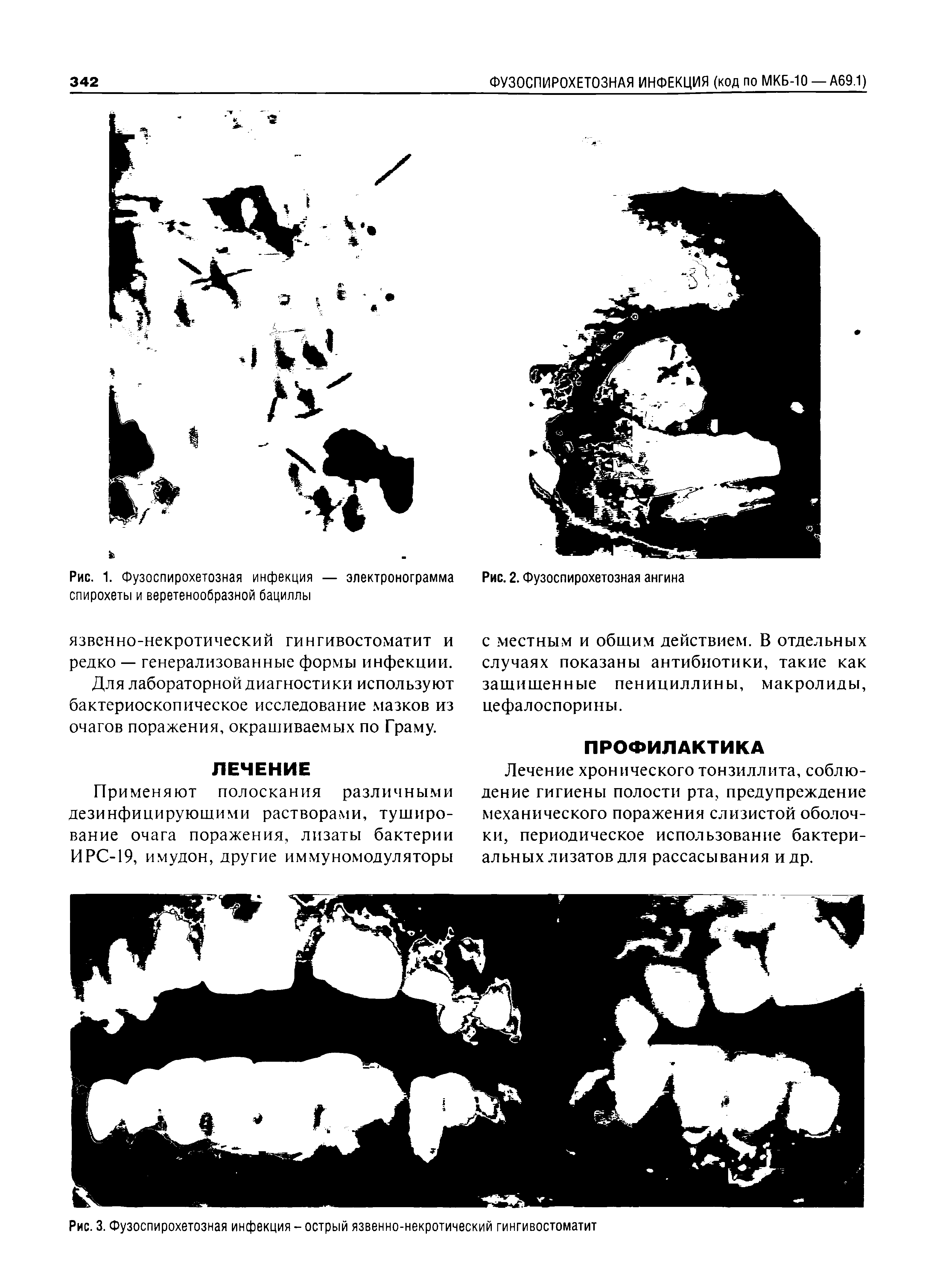 Рис. 3. Фузоспирохетозная инфекция - острый язвенно-некротический гингивостоматит...